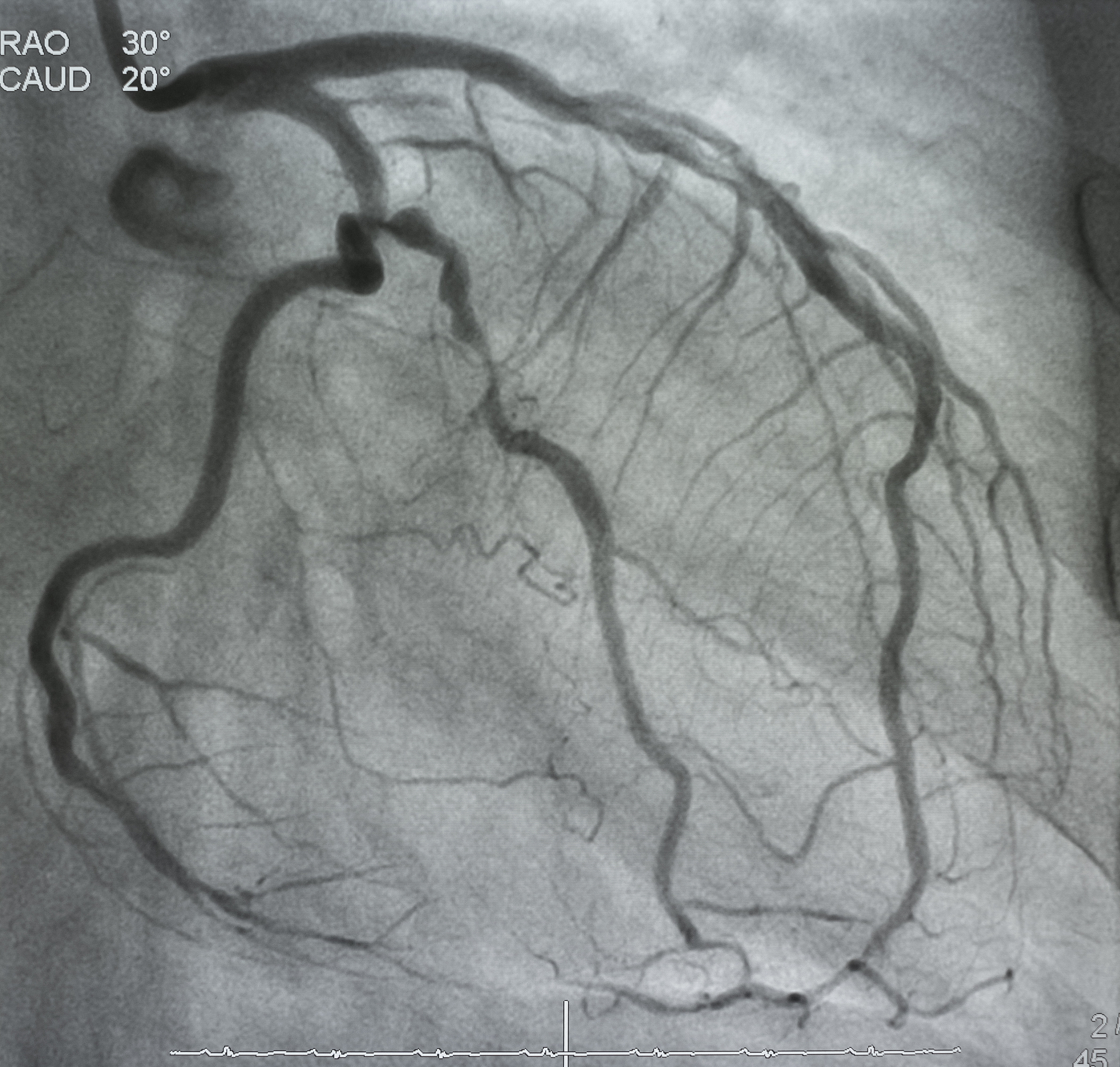 肝动脉造影1次下腔静脉滤器取出术2次腹主动脉支架置入术1次手术分析记录及改进措施