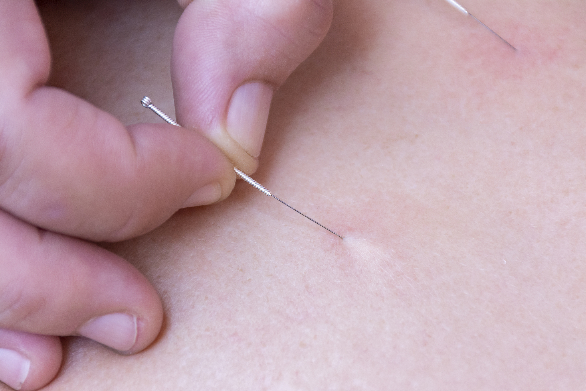 removing an acupuncture needle
