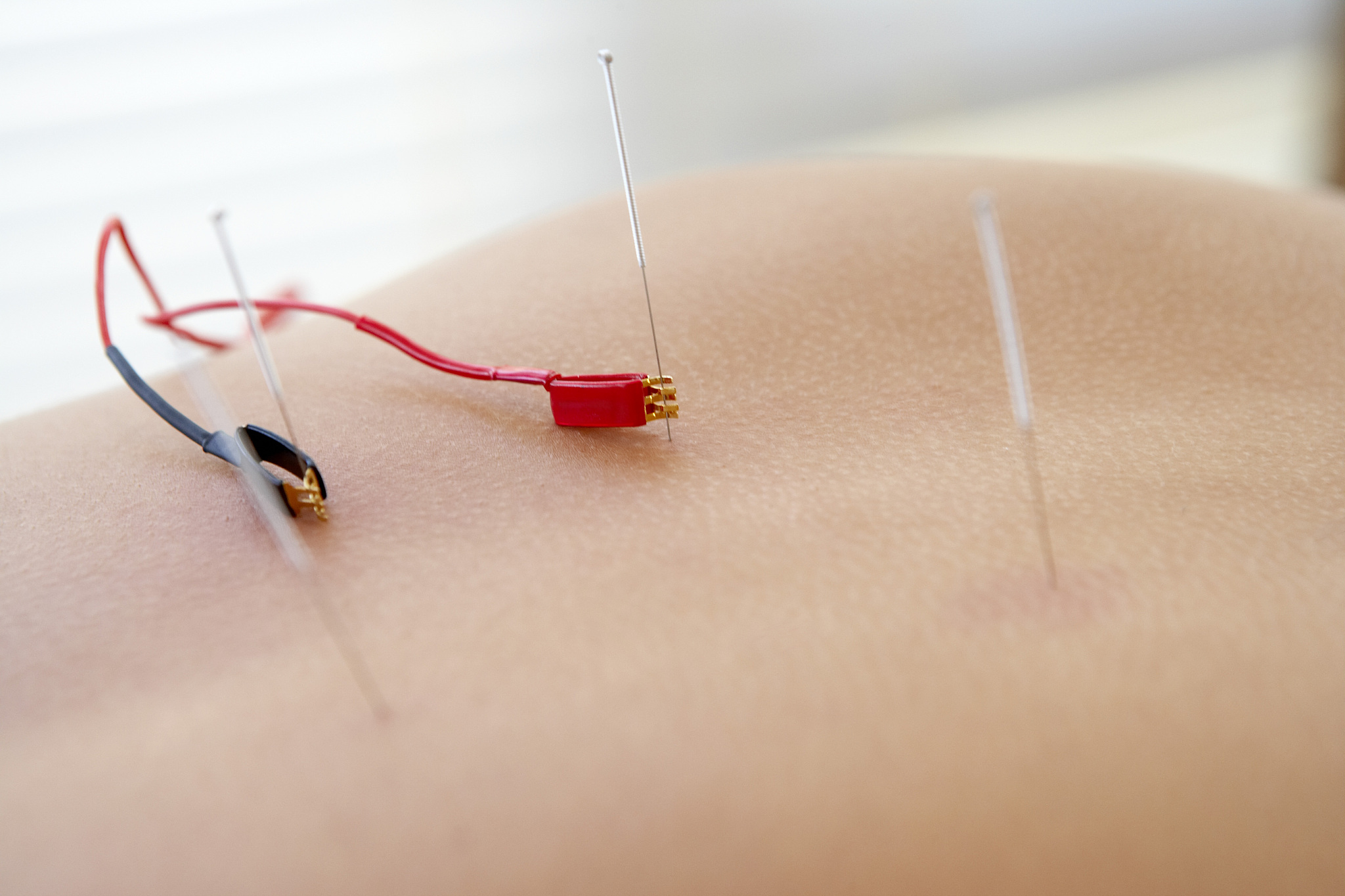 electric cables attached to acupuncture needles