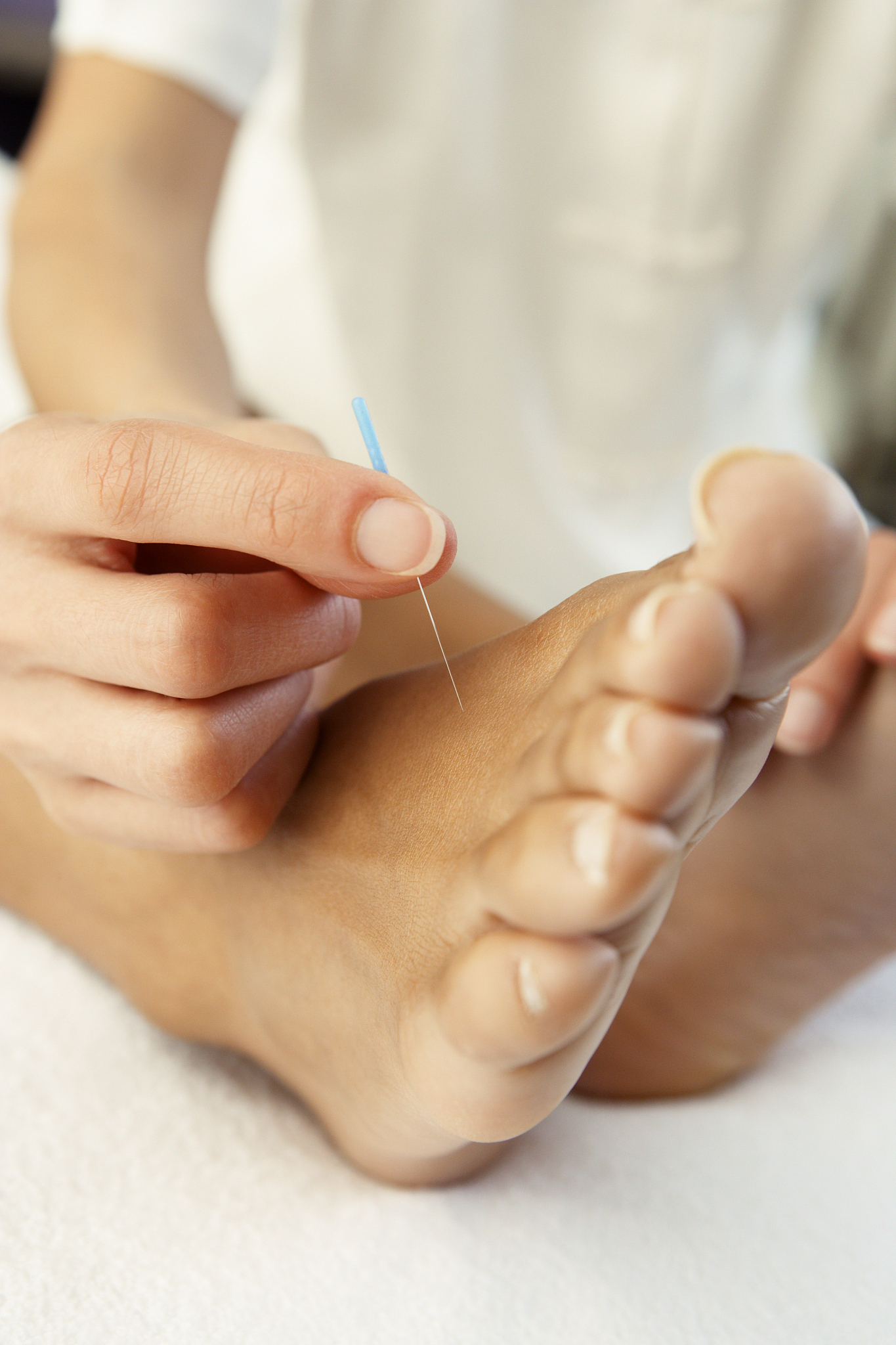 close up of acupuncture treatment