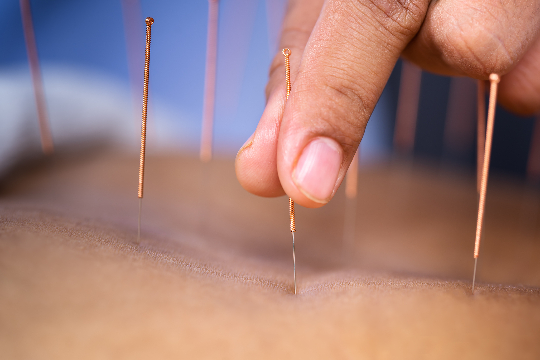 close-up of person getting acupuncture therapy