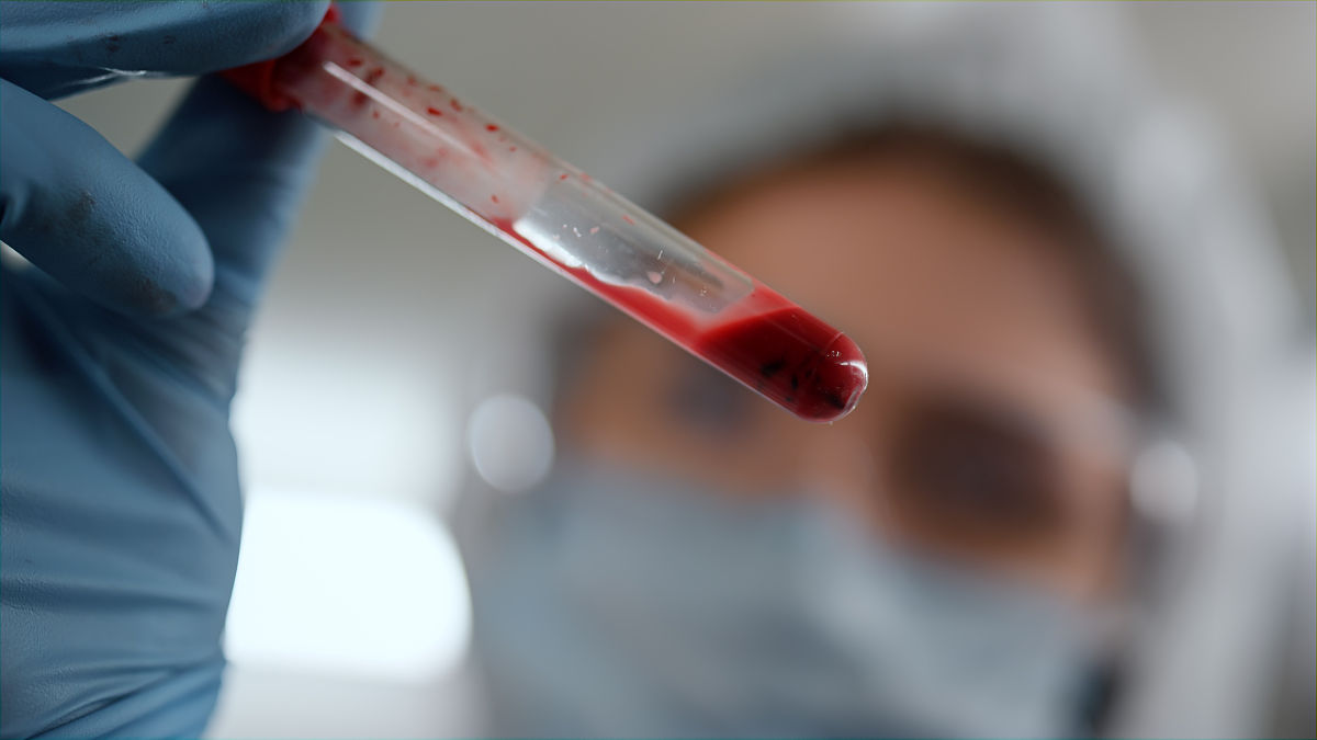 人凝血因子治疗血友病