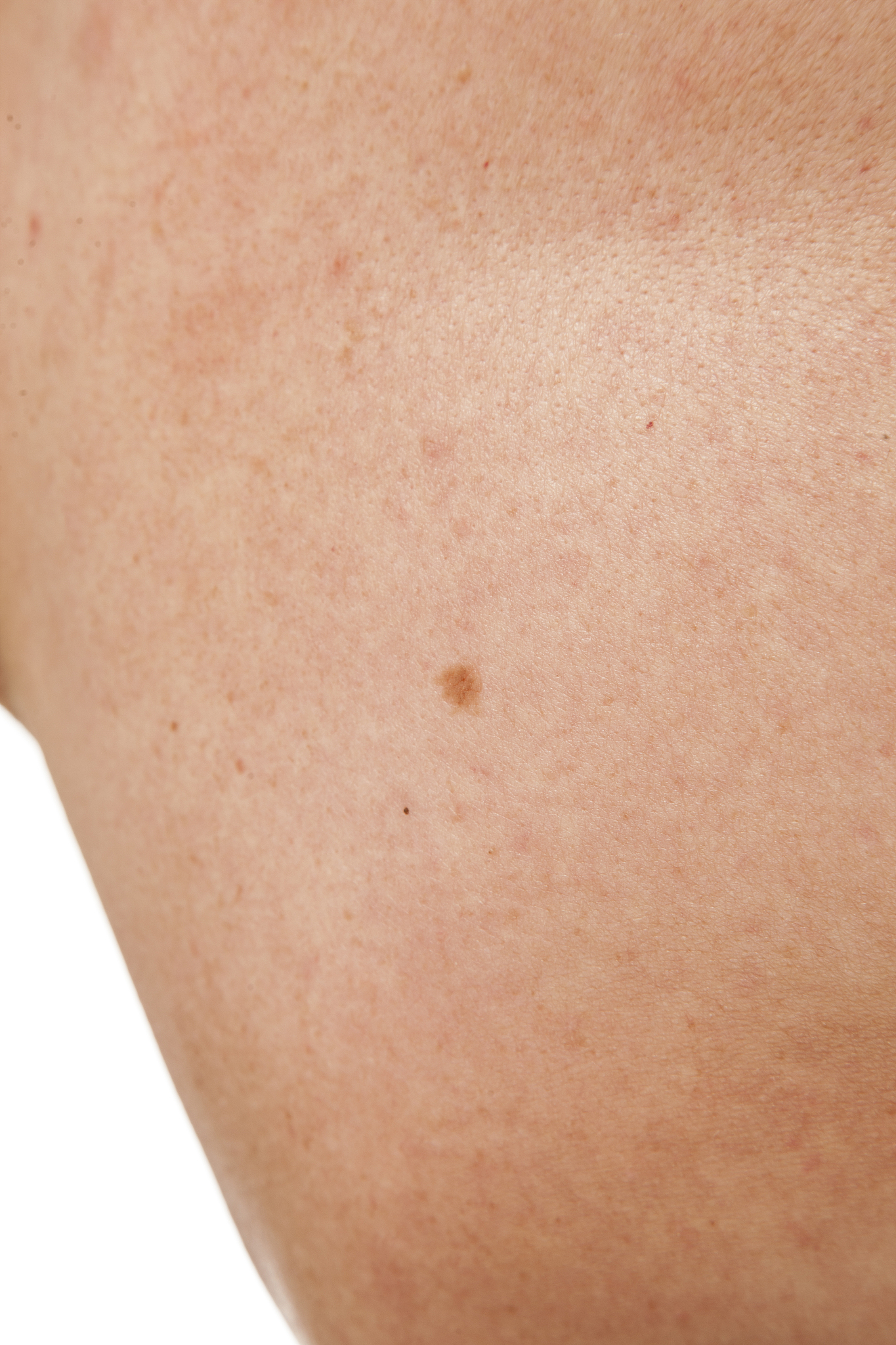 keratinizing squamous cell carcinoma of the skin