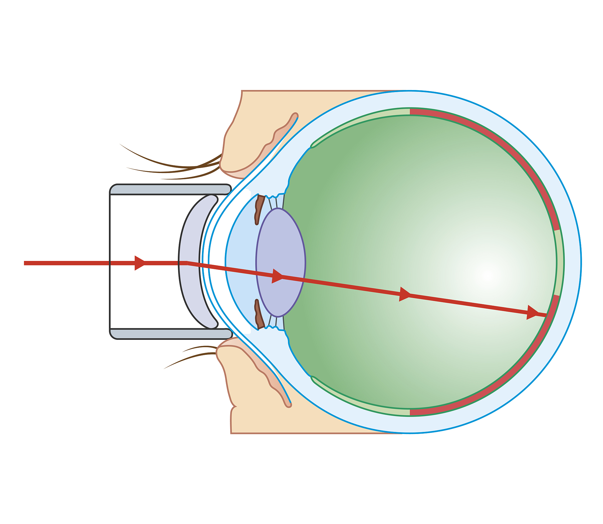 眼睛散光加重的原因：眼球、角膜、晶状体、疾病、药物等因素