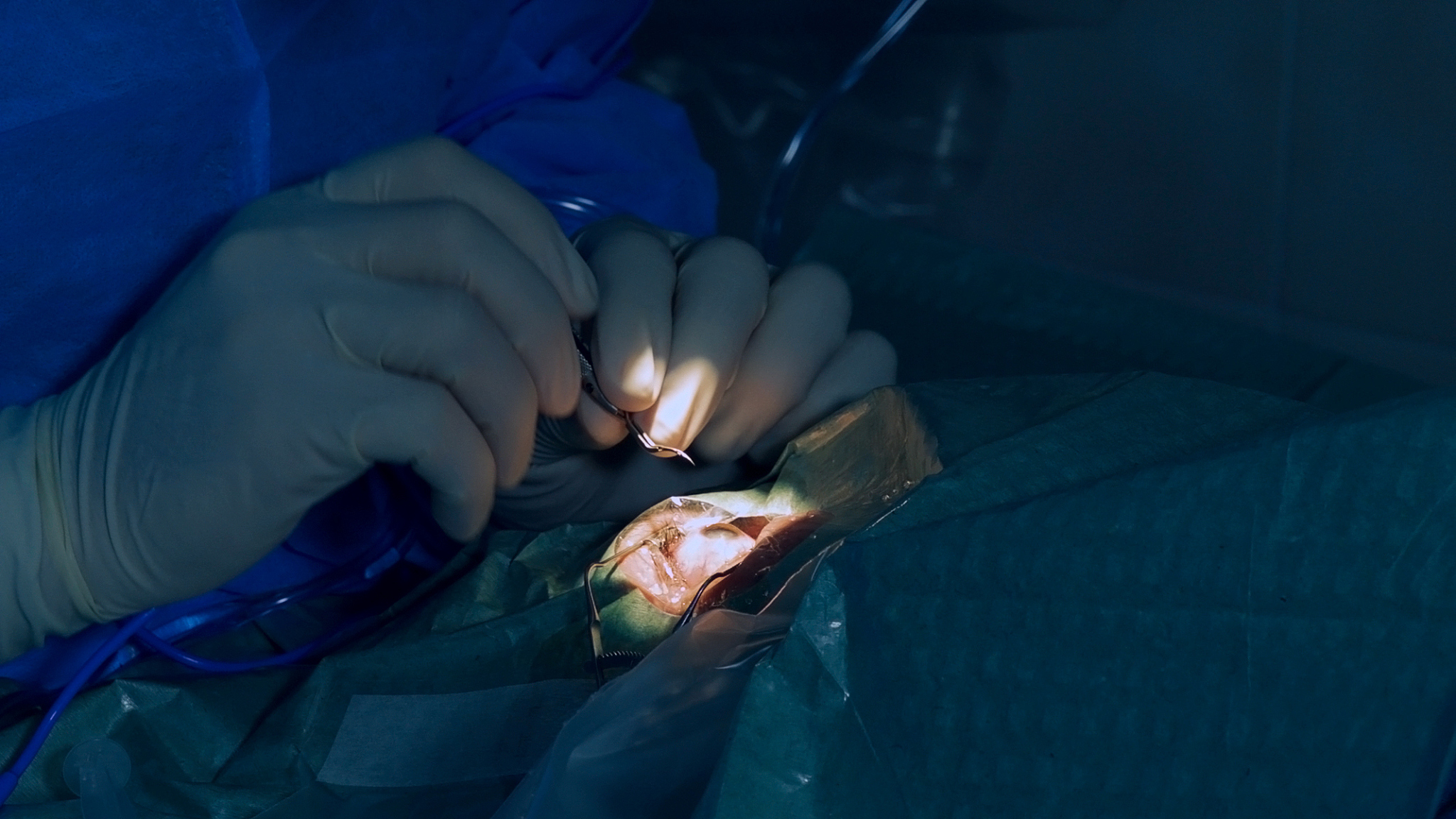 eye microsurgery. medical operation
