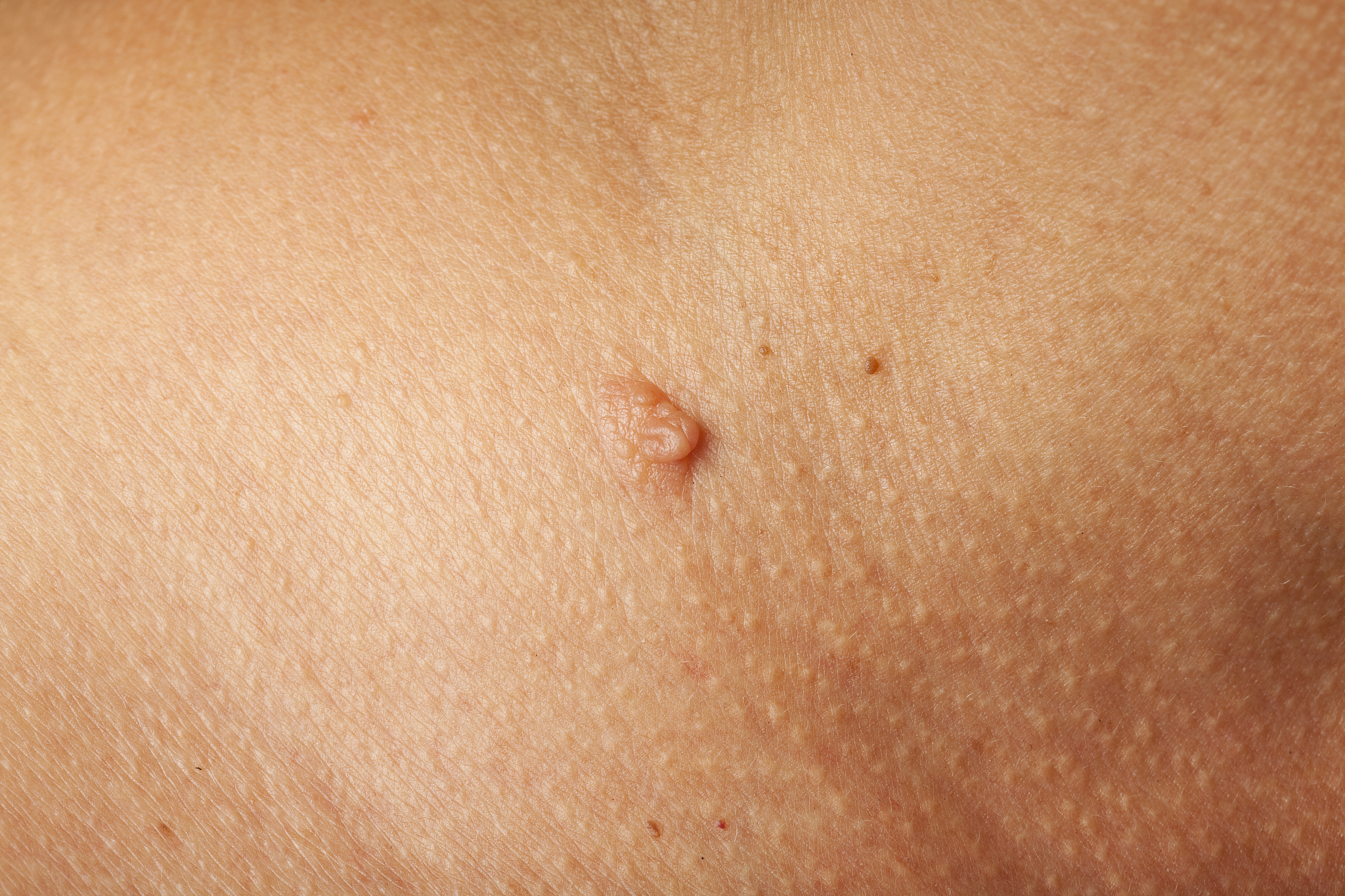 skin wart