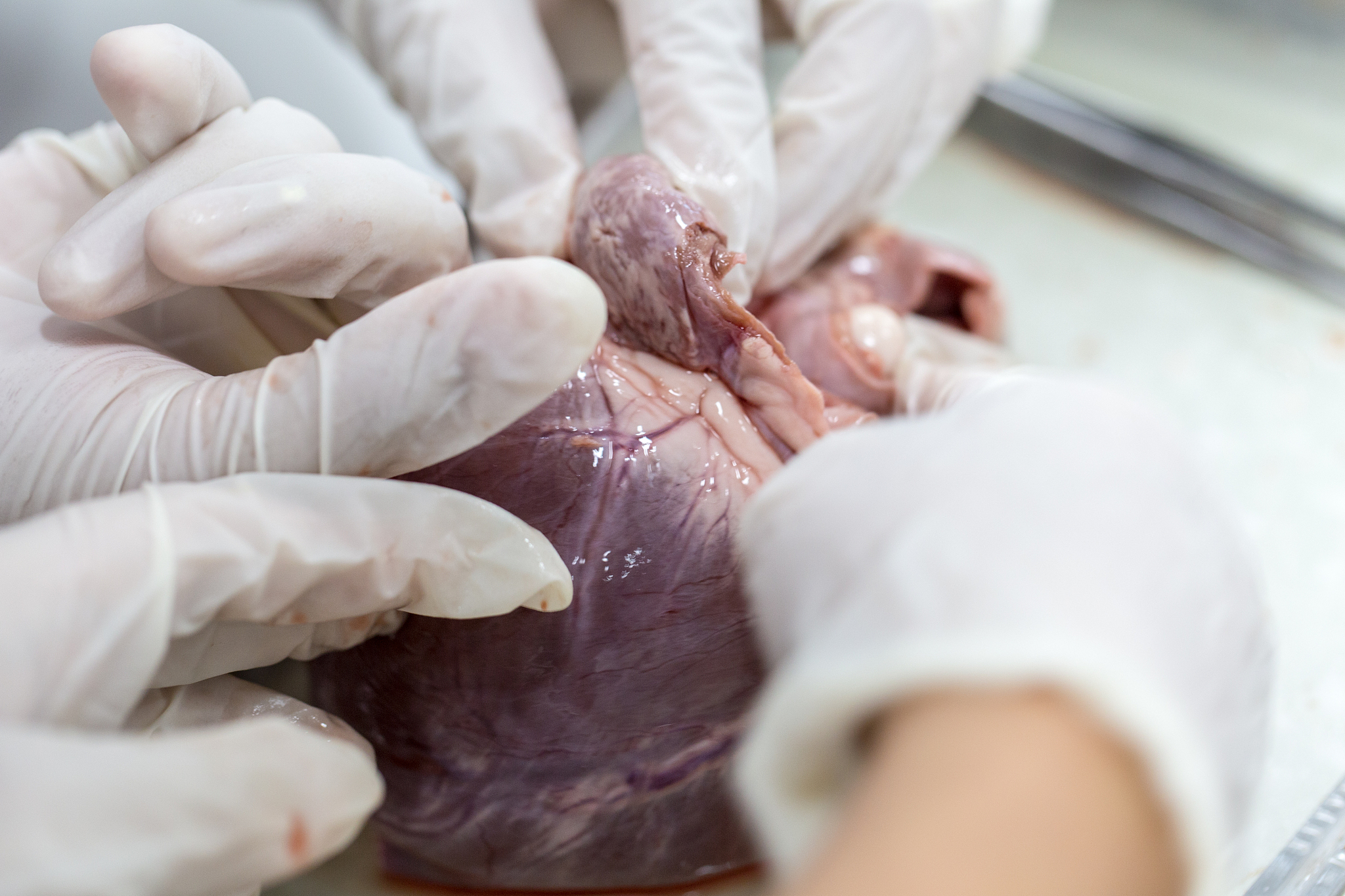 世界首例猪肾脏移植人体手术是否成功了