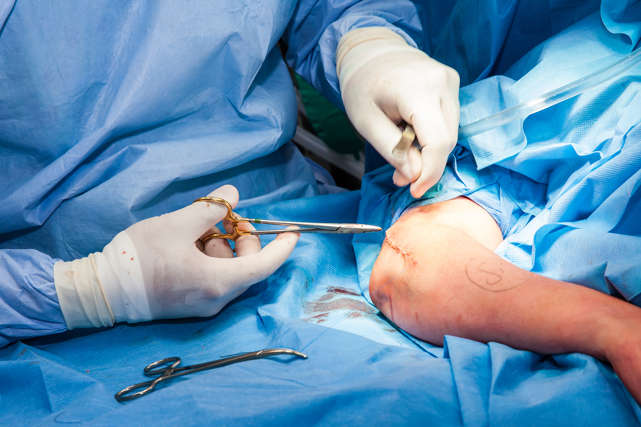 surgeon suturing the arm of a patient at the end of surgery