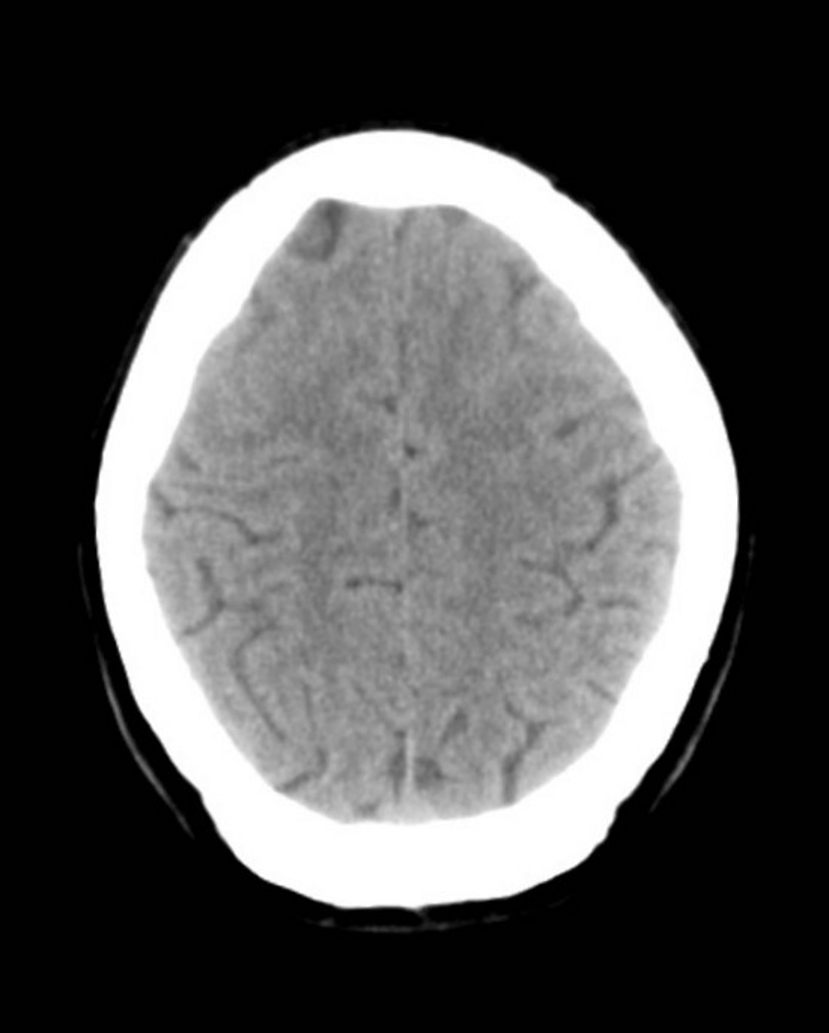 神经鞘瘤病（schwannomatosis）: 症状、病因和治疗