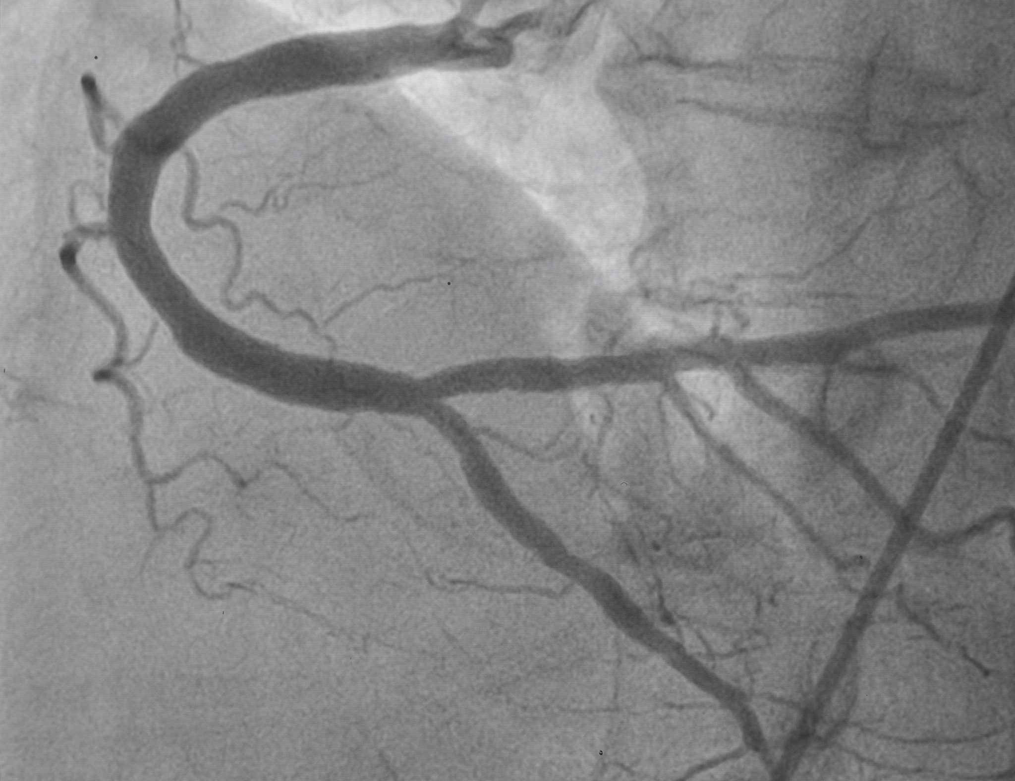 颈动脉易损斑块破裂：早期诊断至关重要，超声造影是首选方法