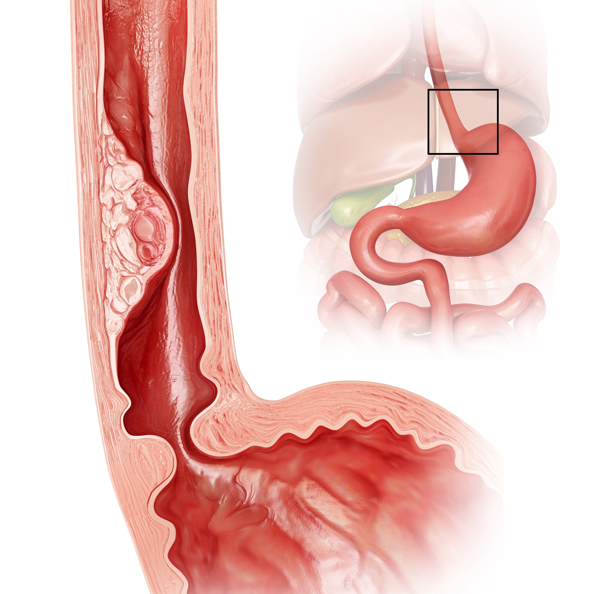 全胃切除+食管空肠吻合术后:运动&休息护理指南(高血压适用)
