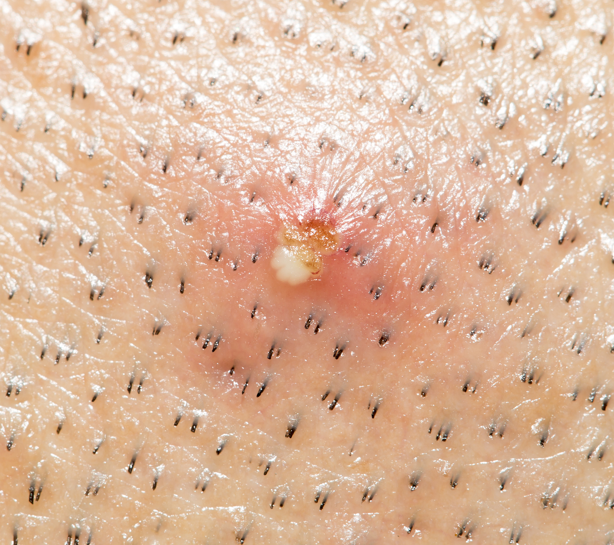 acne on the skin. close