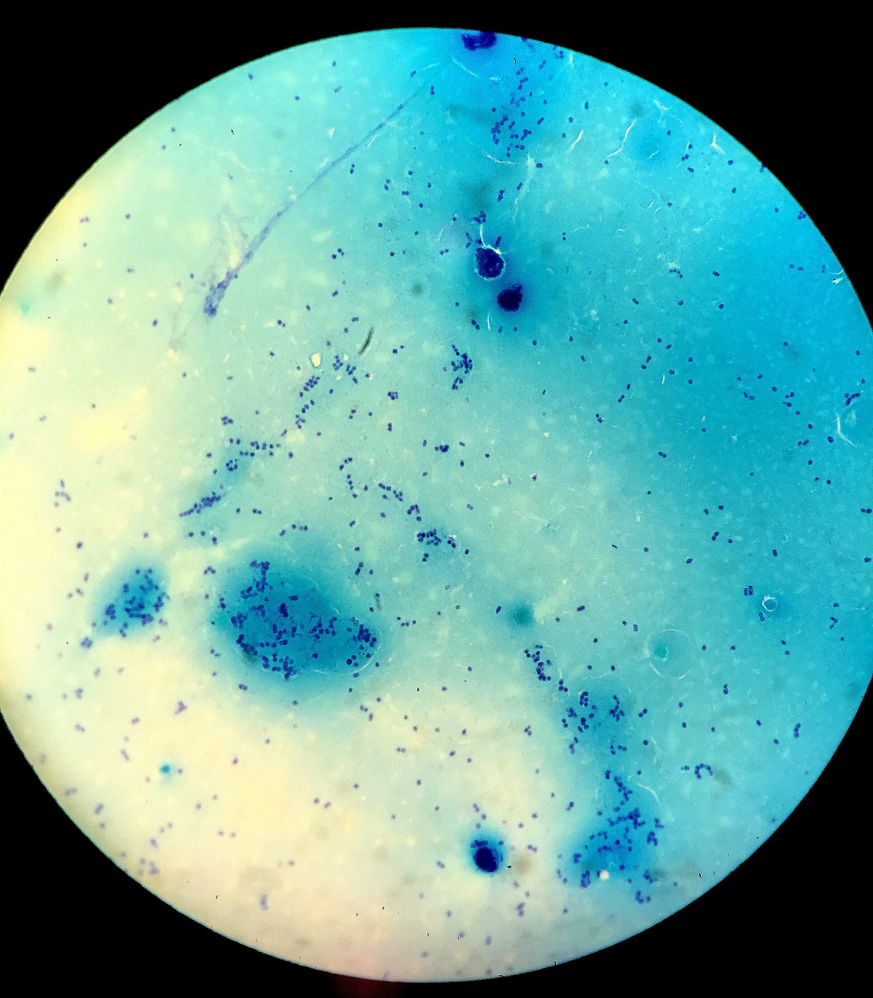 脑膜炎的症状：混浊脊髓液不是征兆