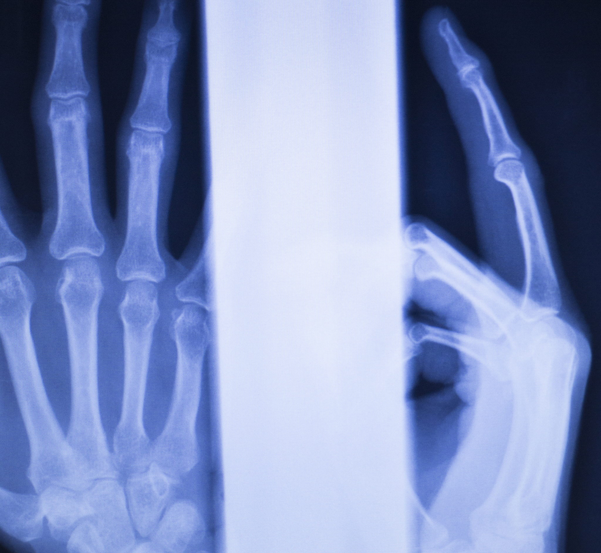 桡骨远端干骺端背侧粉碎性骨折：原因、症状和治疗