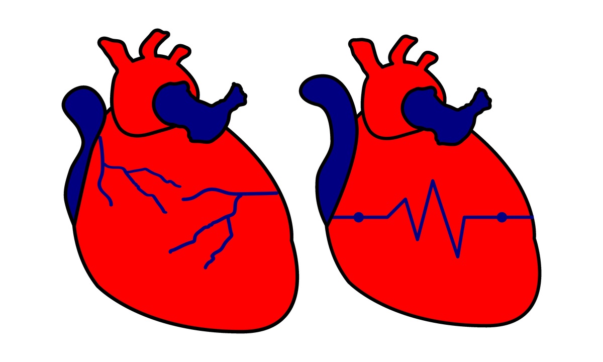 心衰伴心包积液怎么办？心理护理指南助您缓解焦虑