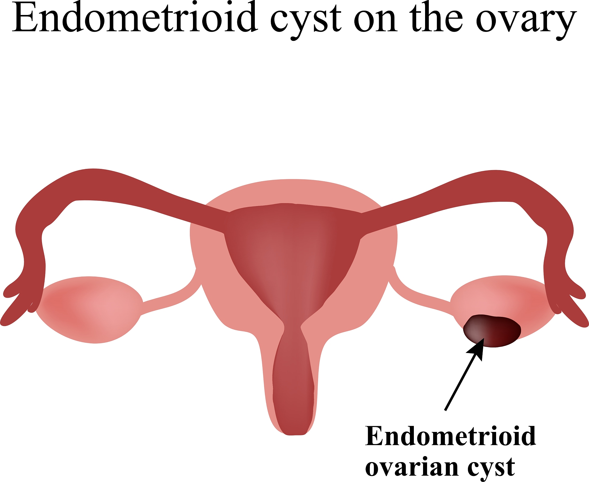 卵巢子宫内膜异位囊肿合并阑尾炎？腹腔镜手术优势明显
