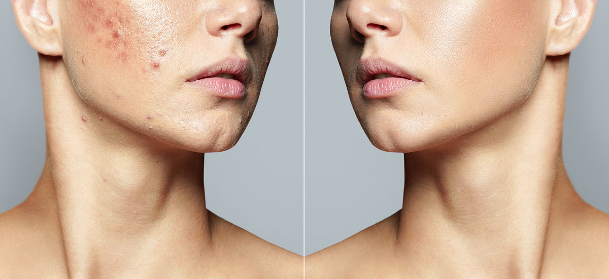 痤疮皮肤如何恢复