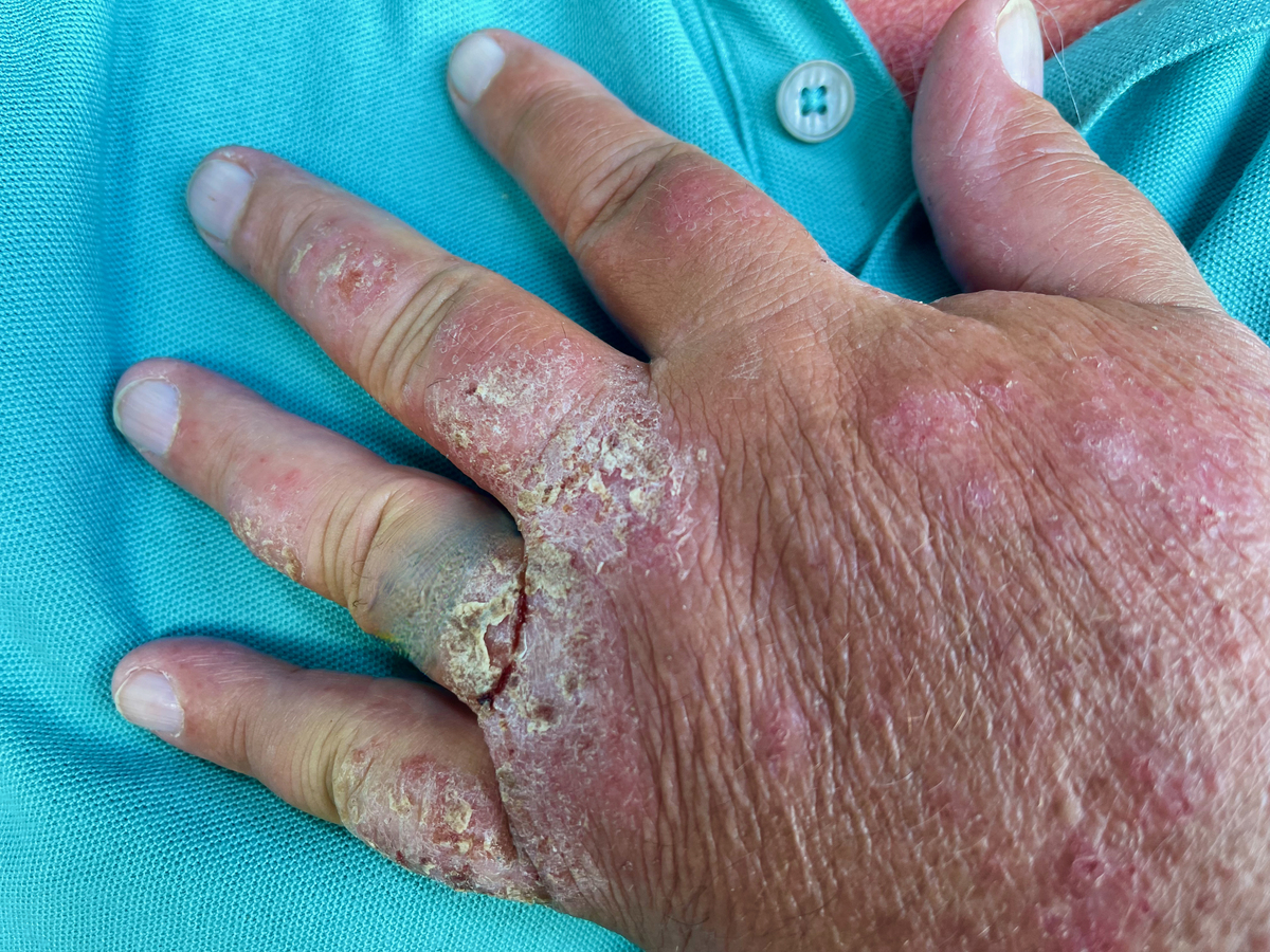 手上长白斑的原因有很多种可以是白癜风其与自身免疫及遗传有关。也可以是老年性白斑或者是单纯糠疹与营养不良及日晒有关。还可能是无色素痣或者是贫血痣后二者与遗传有关。而上述的各种白斑都有其各自不同的临床特点可以通过形态边界是否清楚表面是否脱屑摩擦后是否变红来大致区分也可以采用皮肤CT及皮肤镜检测来区分其治疗和预后也都不相同。重新阐述参照原文分点格式注意文字与原文不能重复语言更丰富逻辑更清晰可科学补充相关