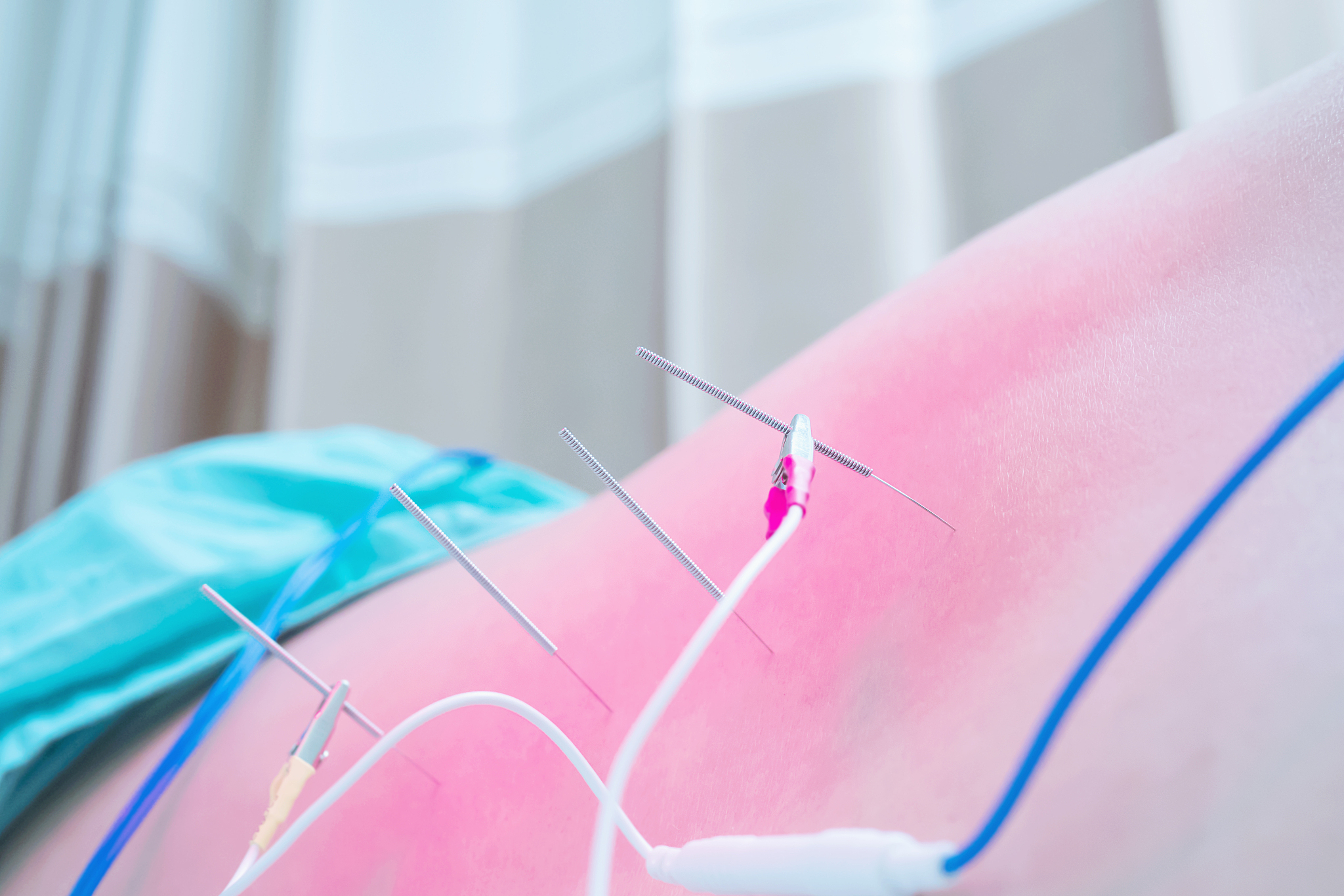 midsection of person at the acupuncture treatment