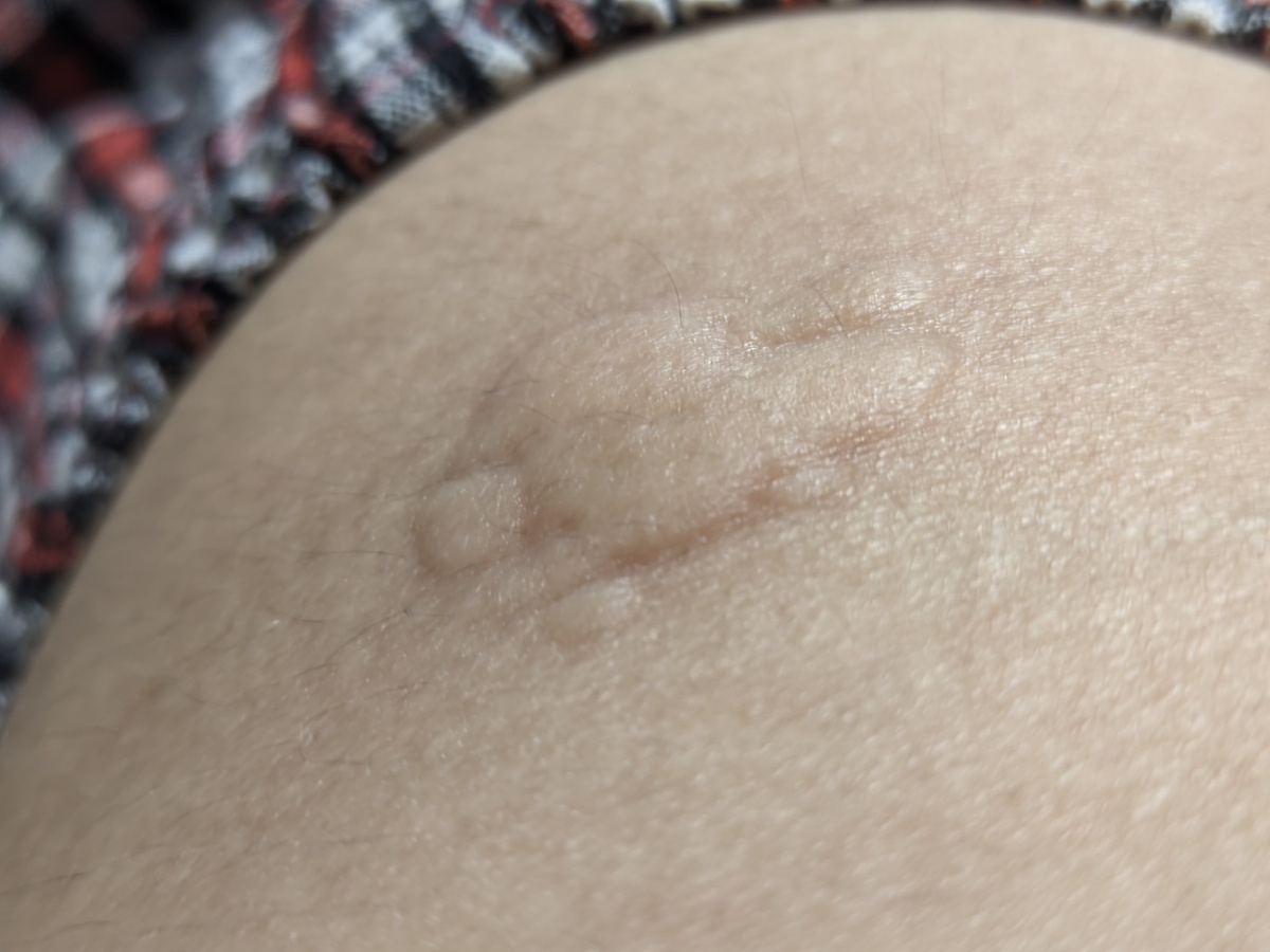 皮肤红肿瘙痒疼痛 - 症状解析及应对方法