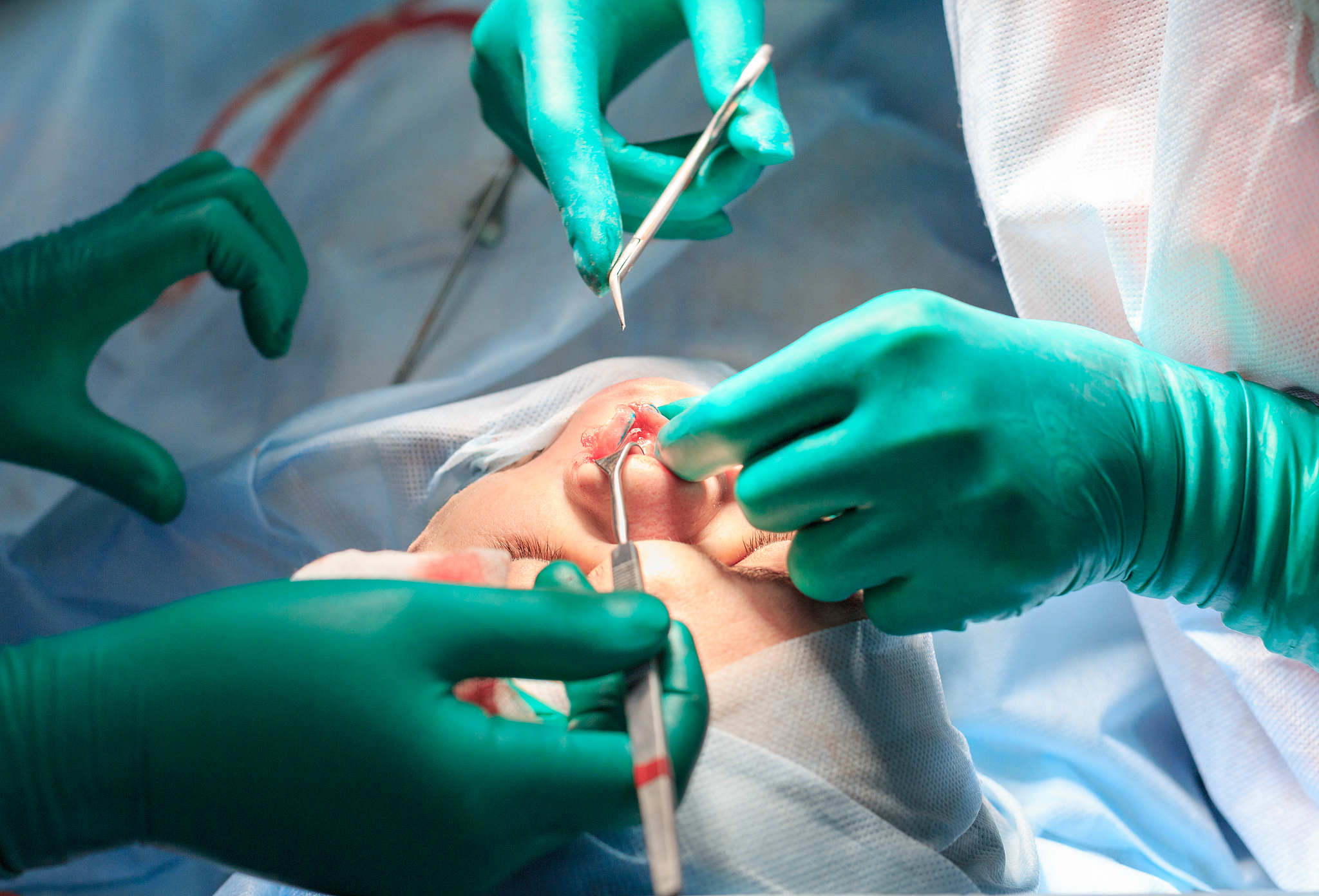 plastic surgery of the nose in operating room, rhinoplasty