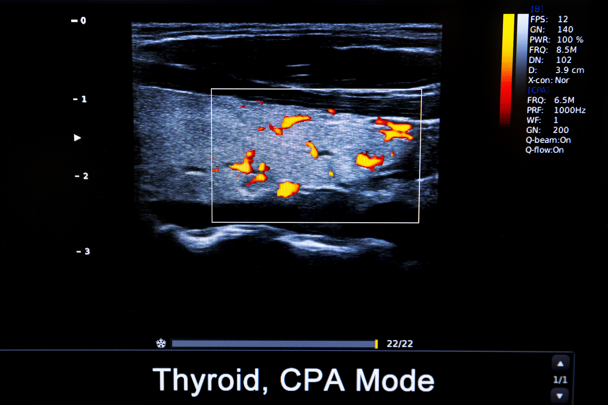 颈动脉斑块新生血管超声造影与手术标本组织学评分的相关性