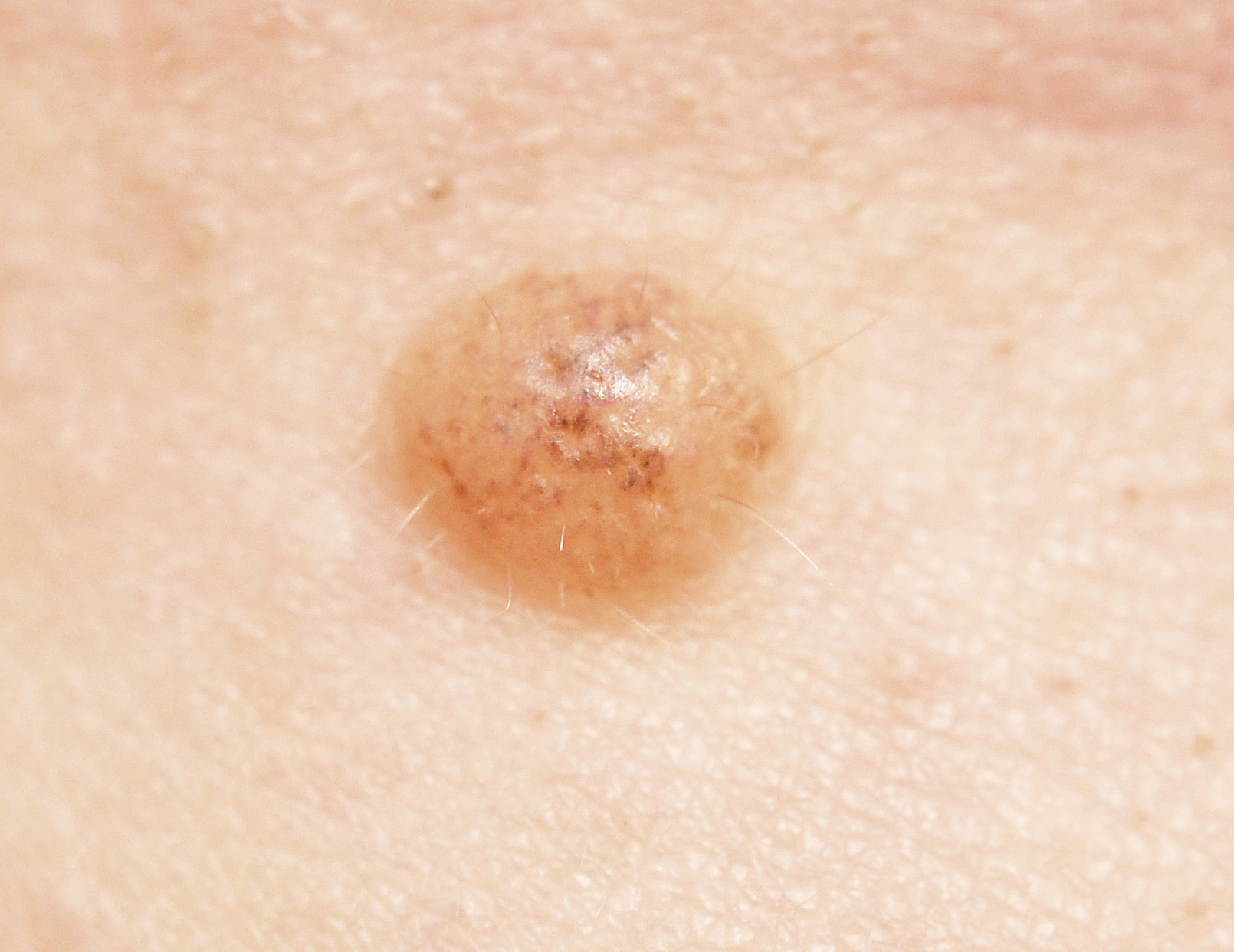 恶性的痣有什么后果