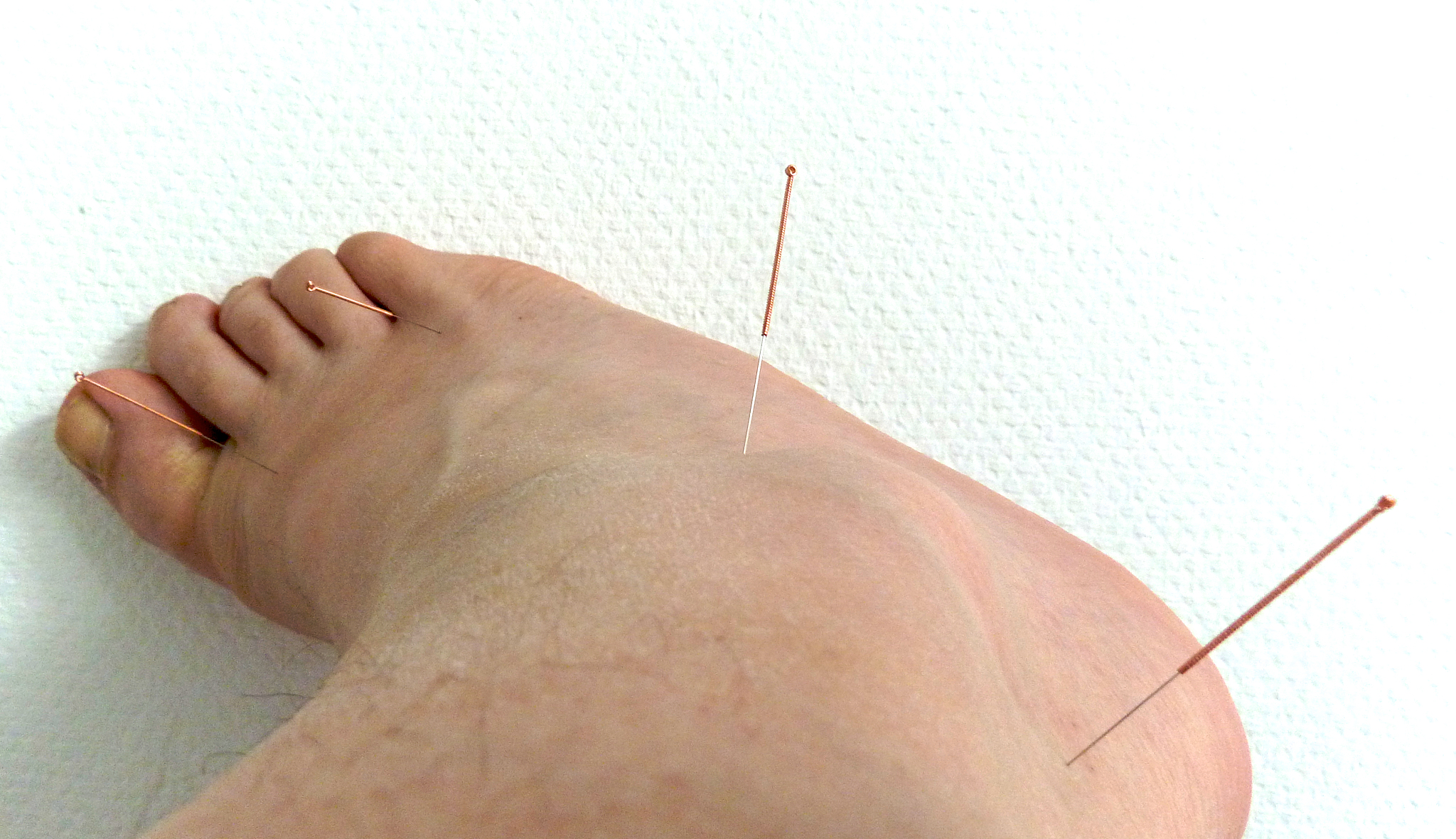 close-up of person with acupuncture needles