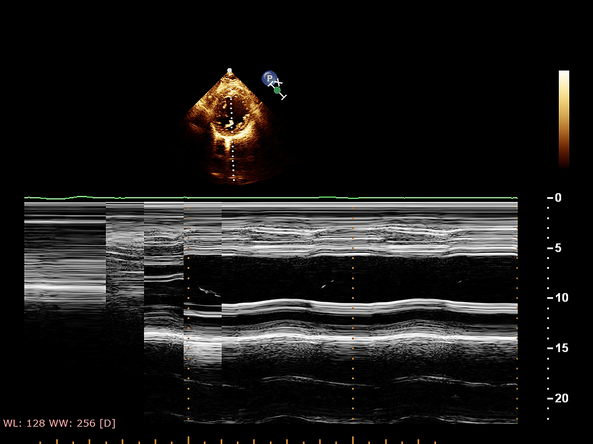 颈动脉斑块破裂合并漂浮血栓形成：罕见的超声造影表现