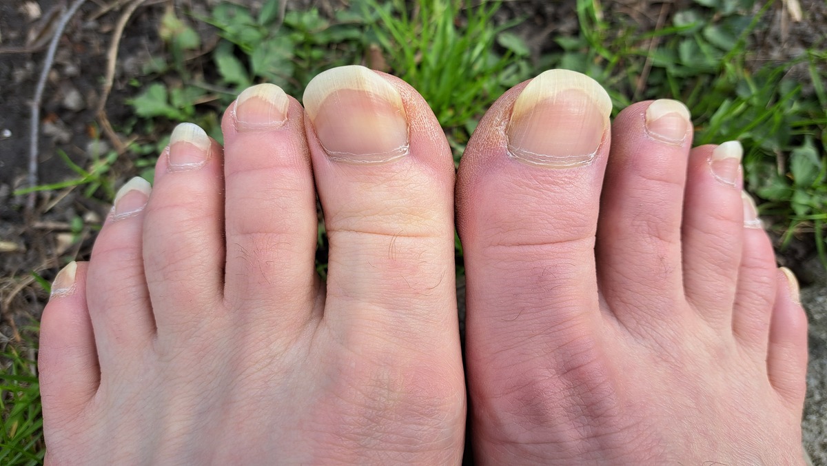 如何预防灰指甲传染？ - 一份全面指南