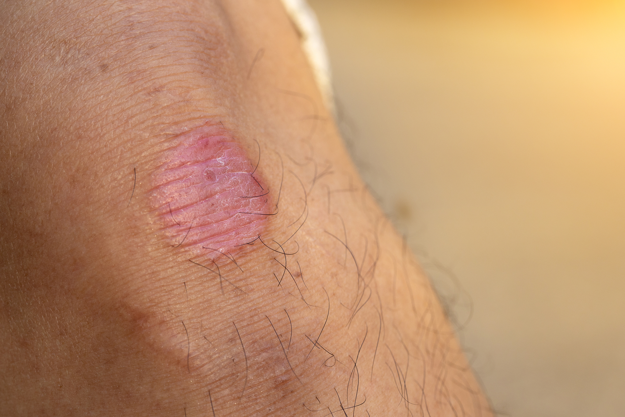 最佳脚气喷雾剂：选择指南和建议