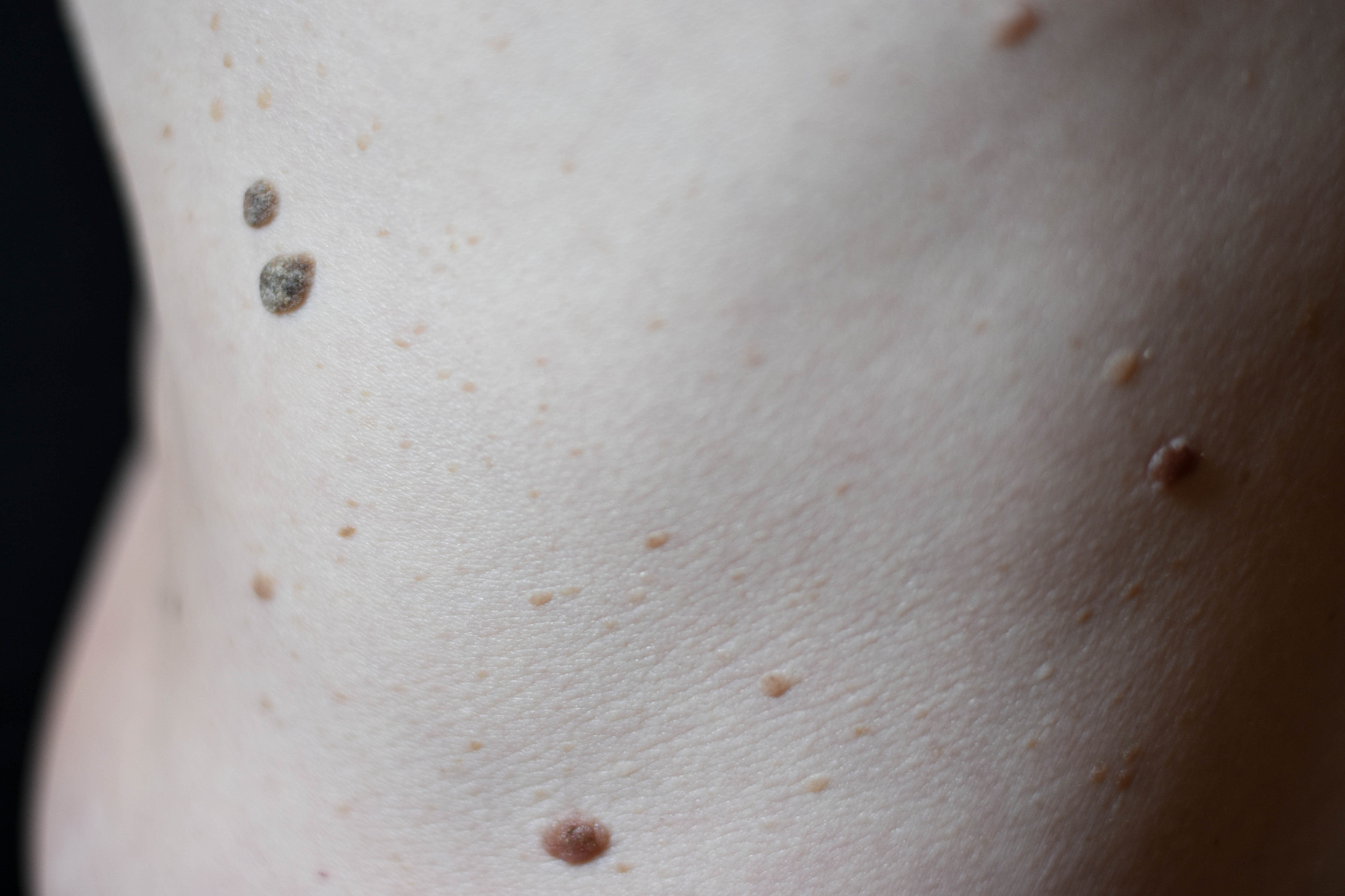 skin texture black birthmarks and moles on skin of woman back