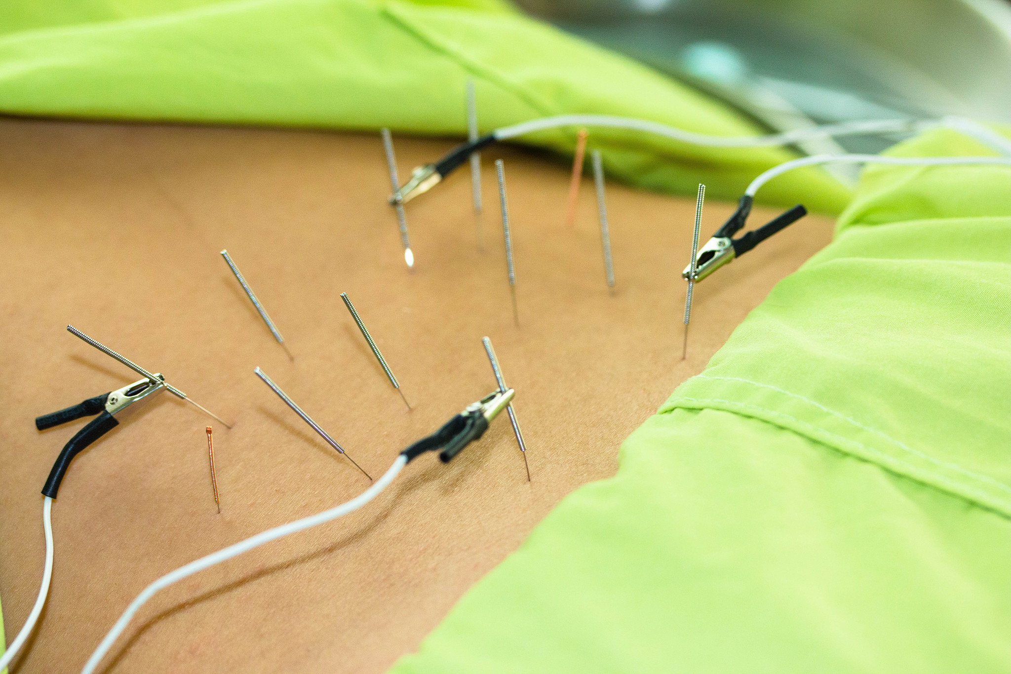 midsection of person with acupuncture needles