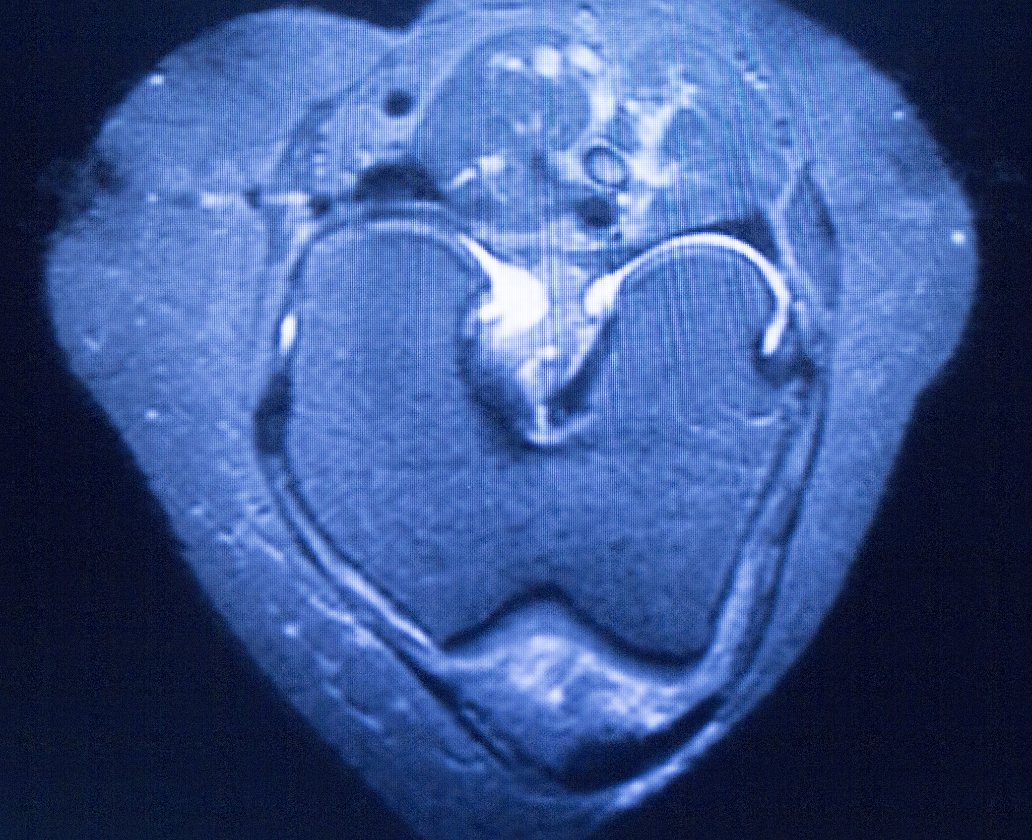 韧带损伤MRI分级（Ⅰ级、Ⅱ级、Ⅲ级）