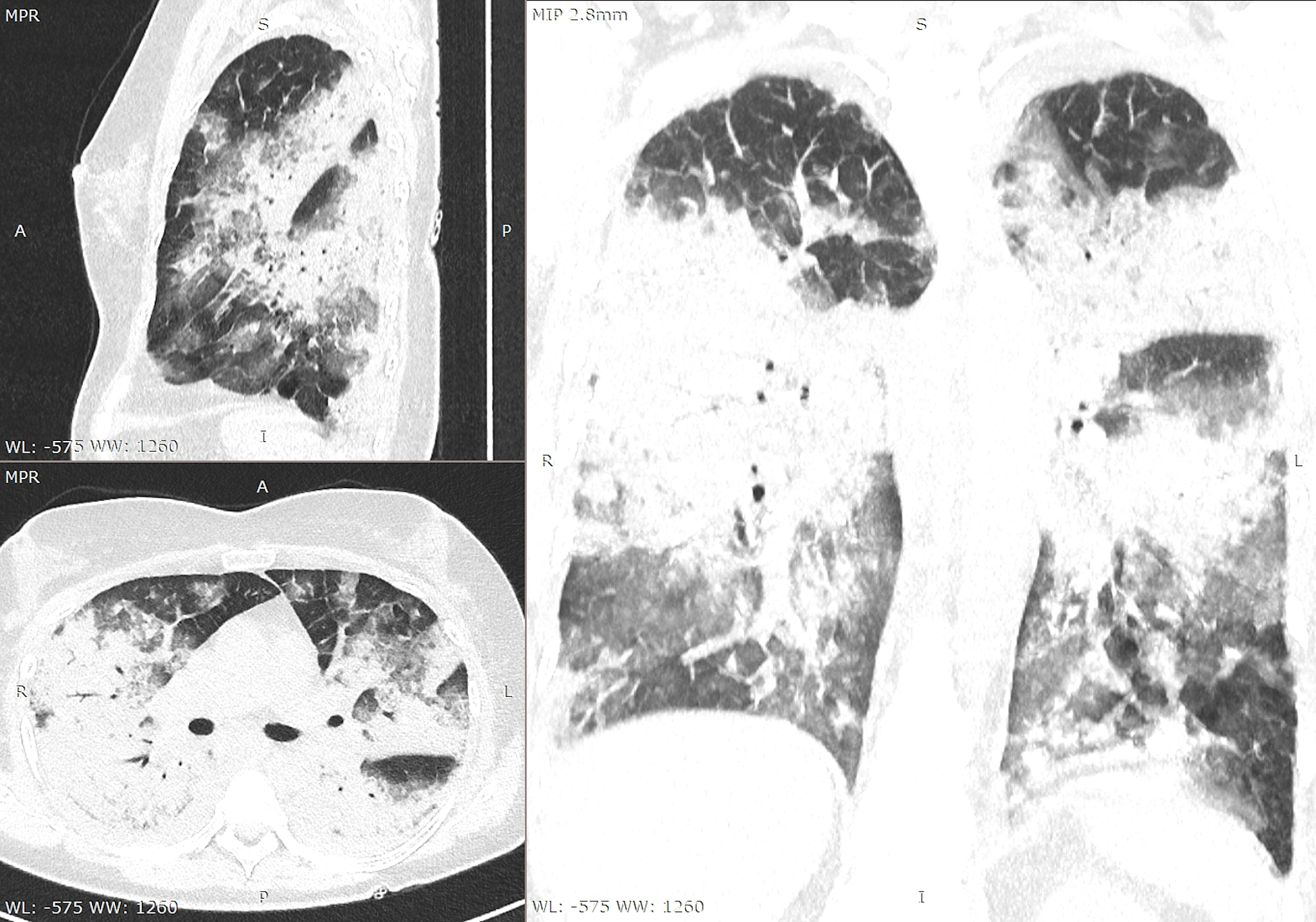 润色并降重以下文字：部位通常由多种组织构成能行使功能的结构单位。基于对984份肺部CT报告及专利一种影像诊断结果的结构化报告系统的分析肺部CT报告的影像所见部分可被分为6个部分分别是双肺区、气管支气管区、肾脏区、心脏区、胸膜区和胸廓区如图332所示。其中部位不是实体为属性。从影像学报告的分析中可以看出部位是非常重要的属性其准确限定了病变发生的位置而特定部位出现特定影像学表现便可确定相应的疾病。