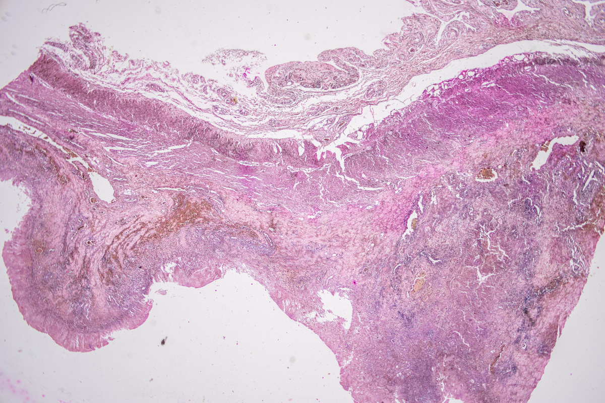 子宫肌瘤特殊类型：富细胞性、静脉内平滑肌瘤、播散性腹膜平滑肌瘤