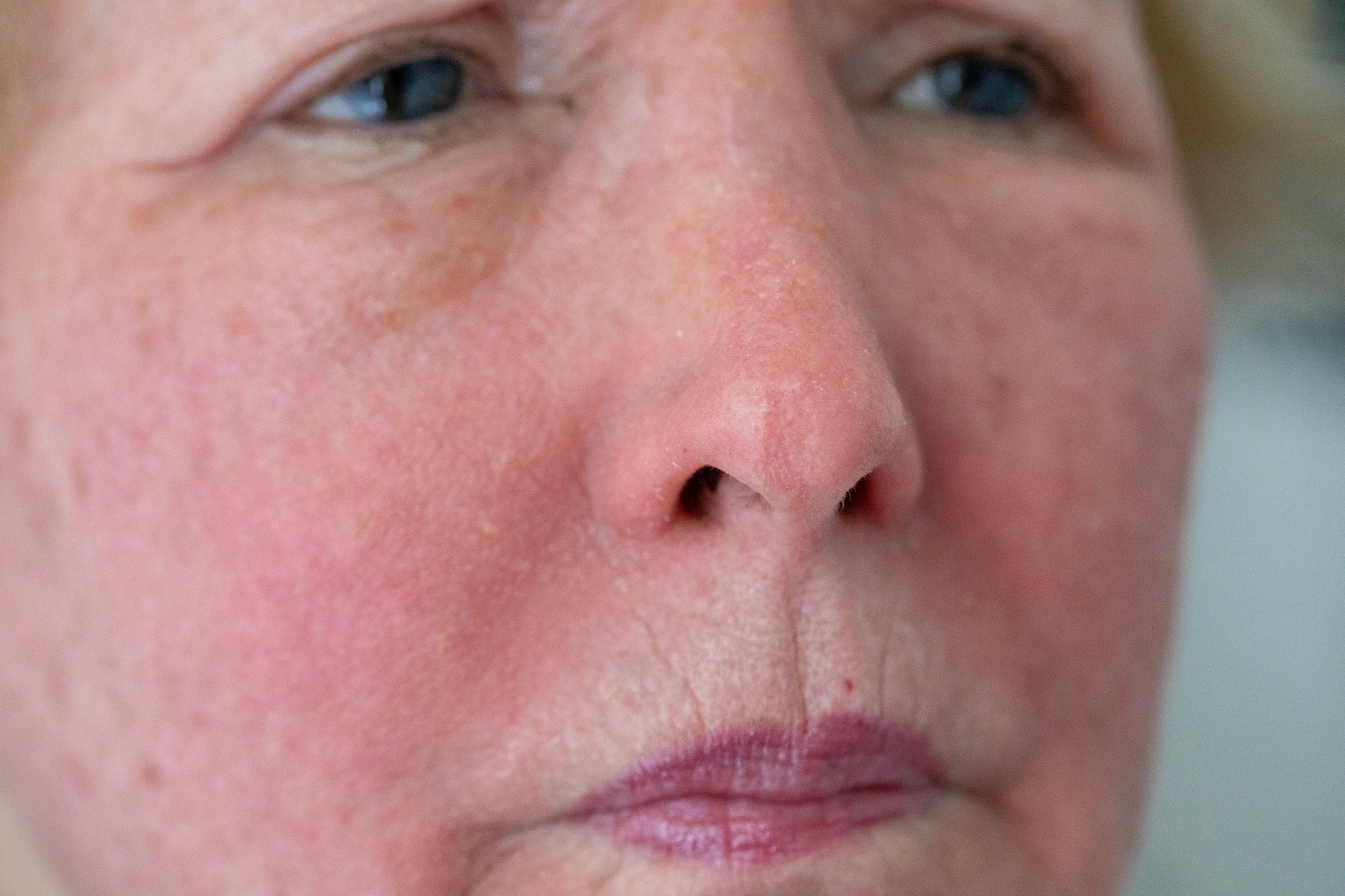 skin allergy