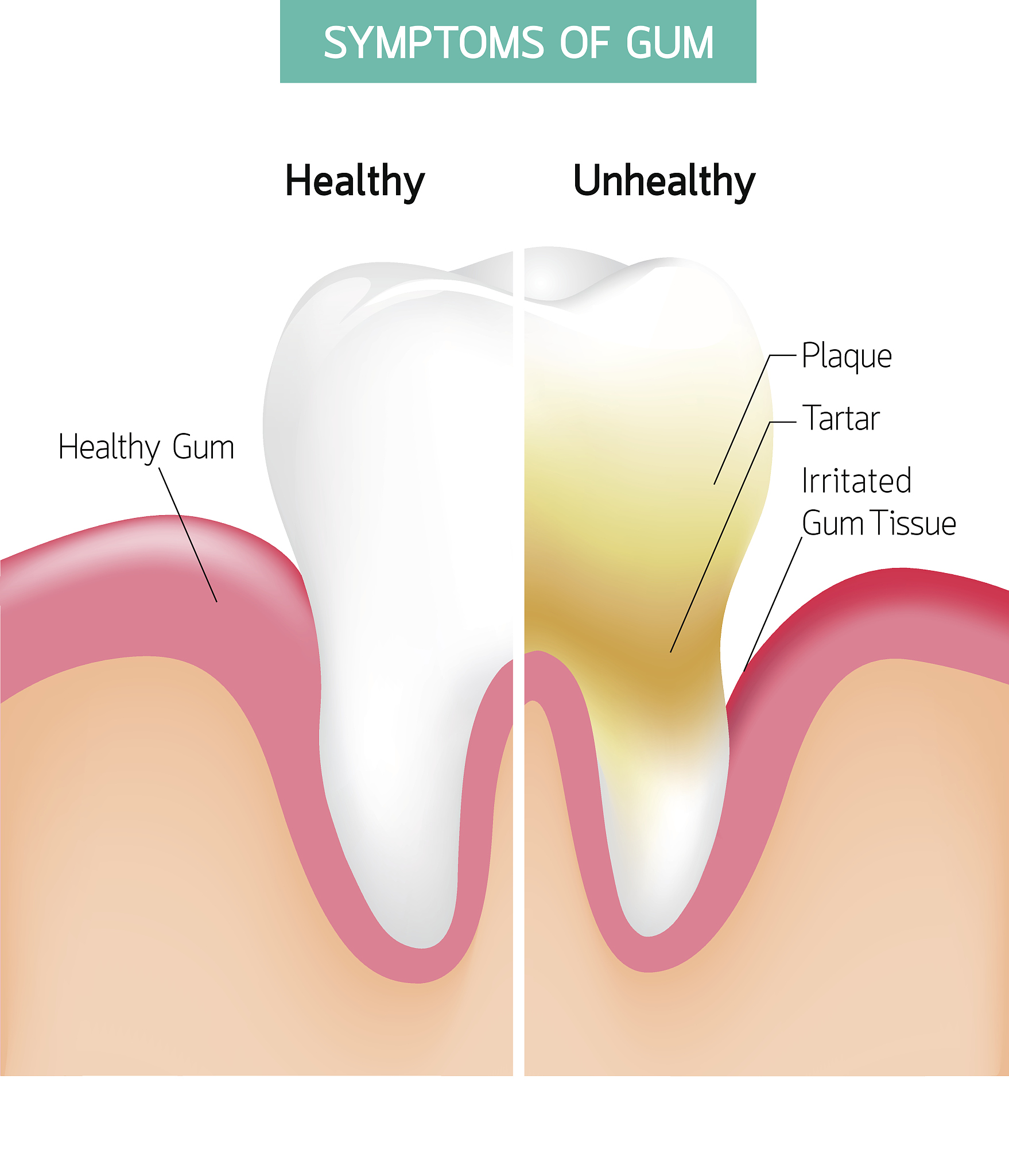 牙本质里面会有很多神经吗？