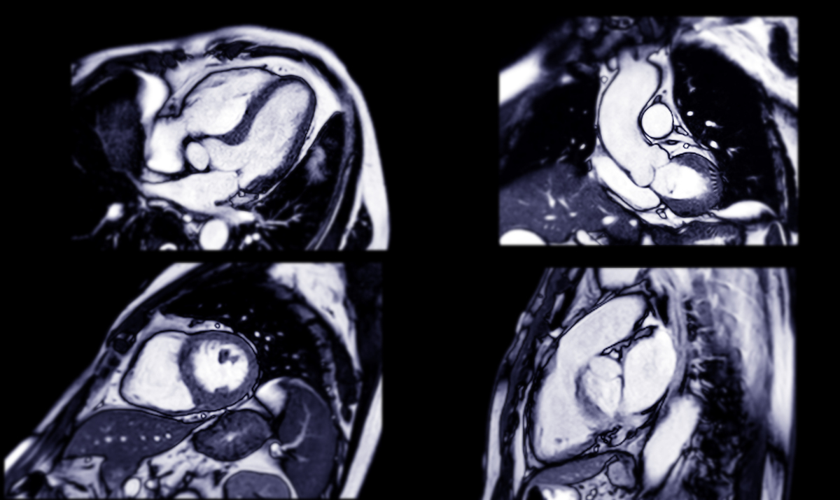 心脏核磁共振成像