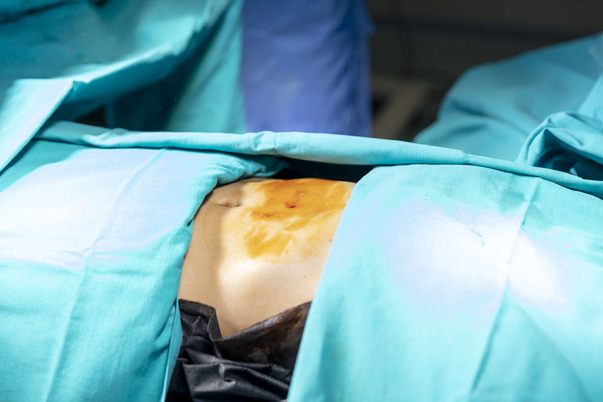 阑尾炎微创多久上厕所