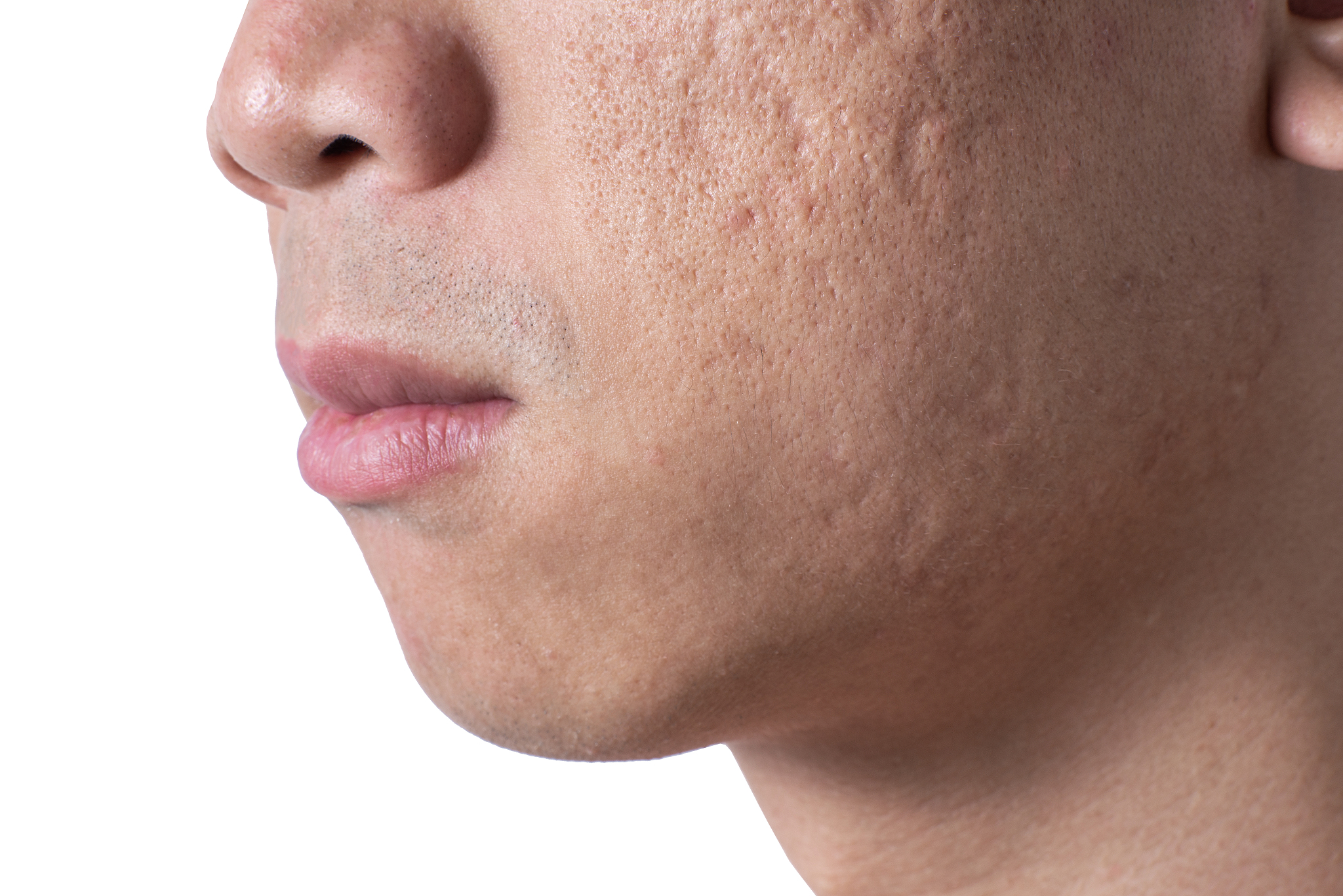 close-up acne and scars on asian man face