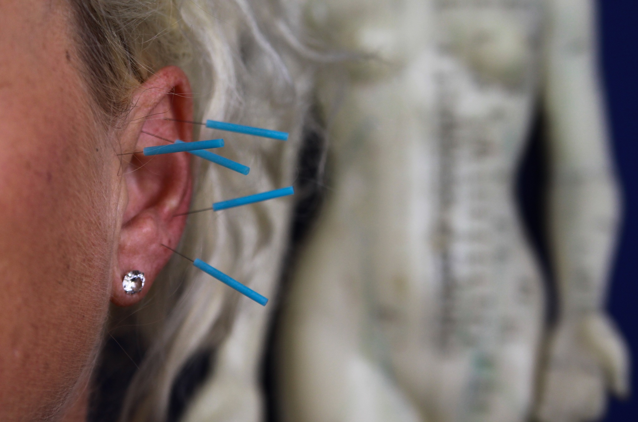 cropped image of woman with acupuncture needles on ear
