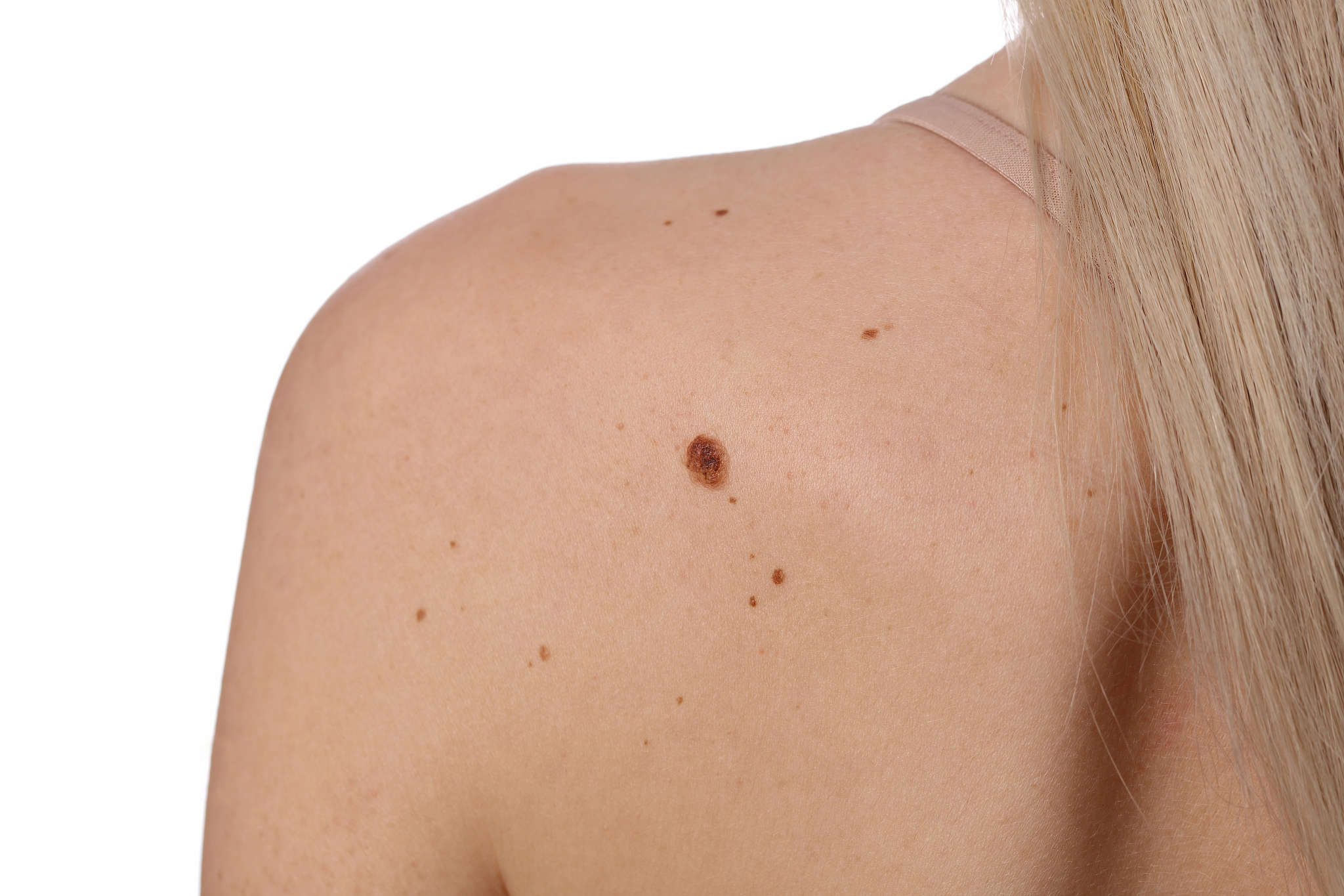 young woman with birthmark on her back, skin isolated on white b