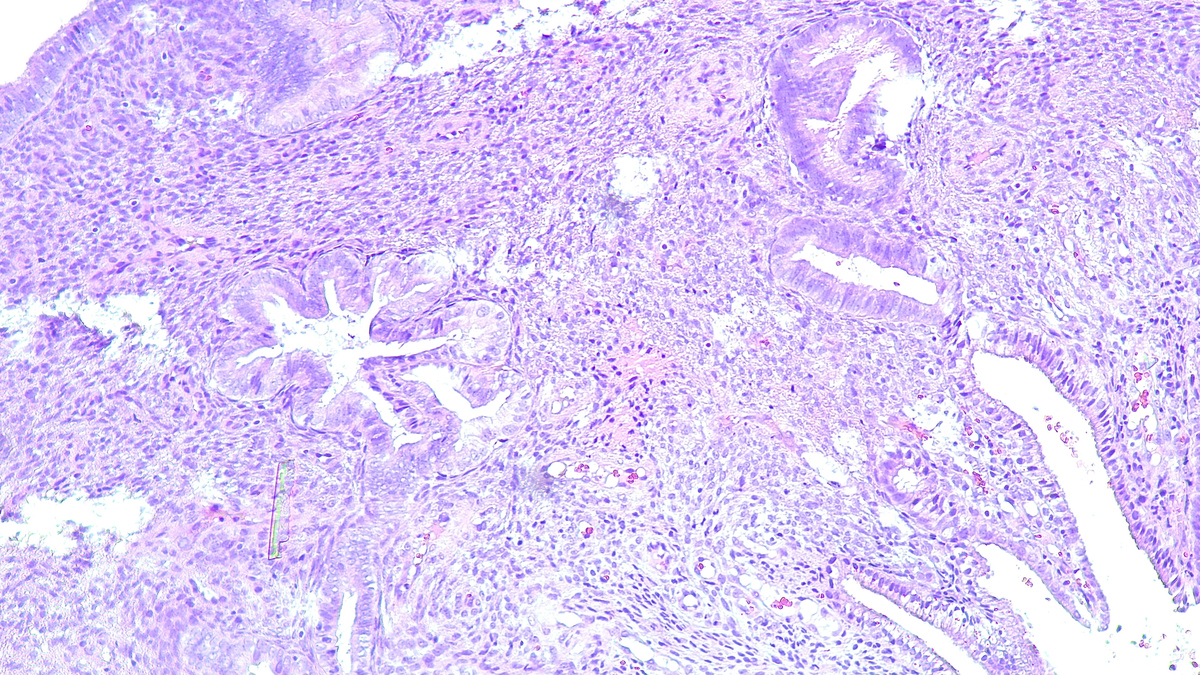 树突状细胞和HSD11B1在子宫内膜异位症中的作用