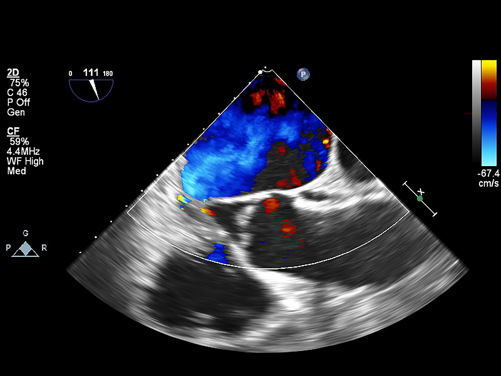 血管内超声诊断导管头端的显影性有什么意义