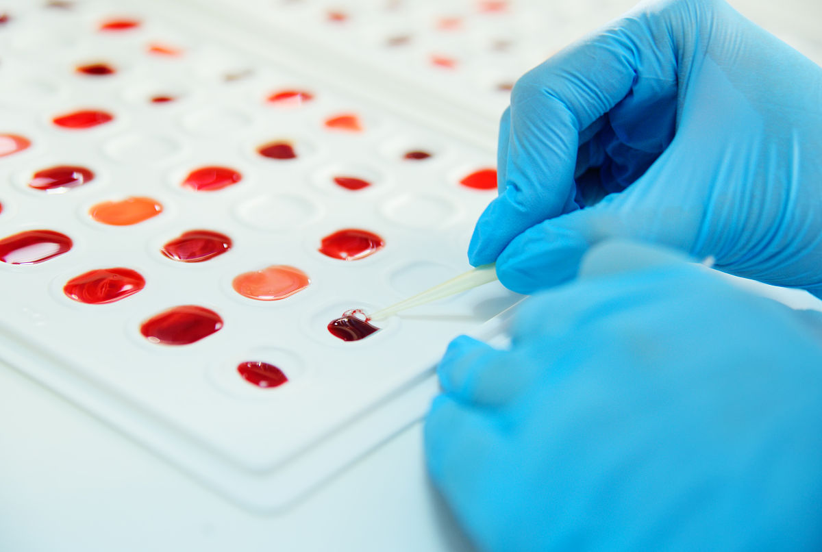 用孕妇血液能检测胎儿血型吗是的通过孕妇血液中的Rh因子和其他血型抗原可以确定胎儿的血型。这种检测称为非侵入性产前血型鉴定通常在孕期第8-10周进行。这种检测方法不会对胎儿或孕妇造成任何伤害因此被广泛接受。如何检测非侵入性产前血型鉴定通常使用母血中的游离胎儿DNAcffDNA进行检测。这些DNA片段来自于胎儿胎盘细胞可以通过母亲的血液流入母体循环系统。检测时从孕妇的血液中提取DNA样本然后使用PCR