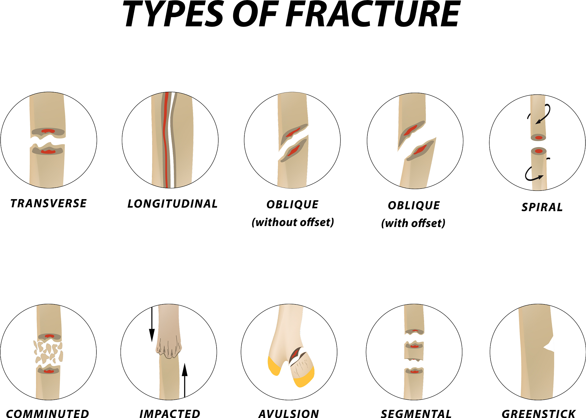 高龄髋部骨折：病因、症状、预防及治疗