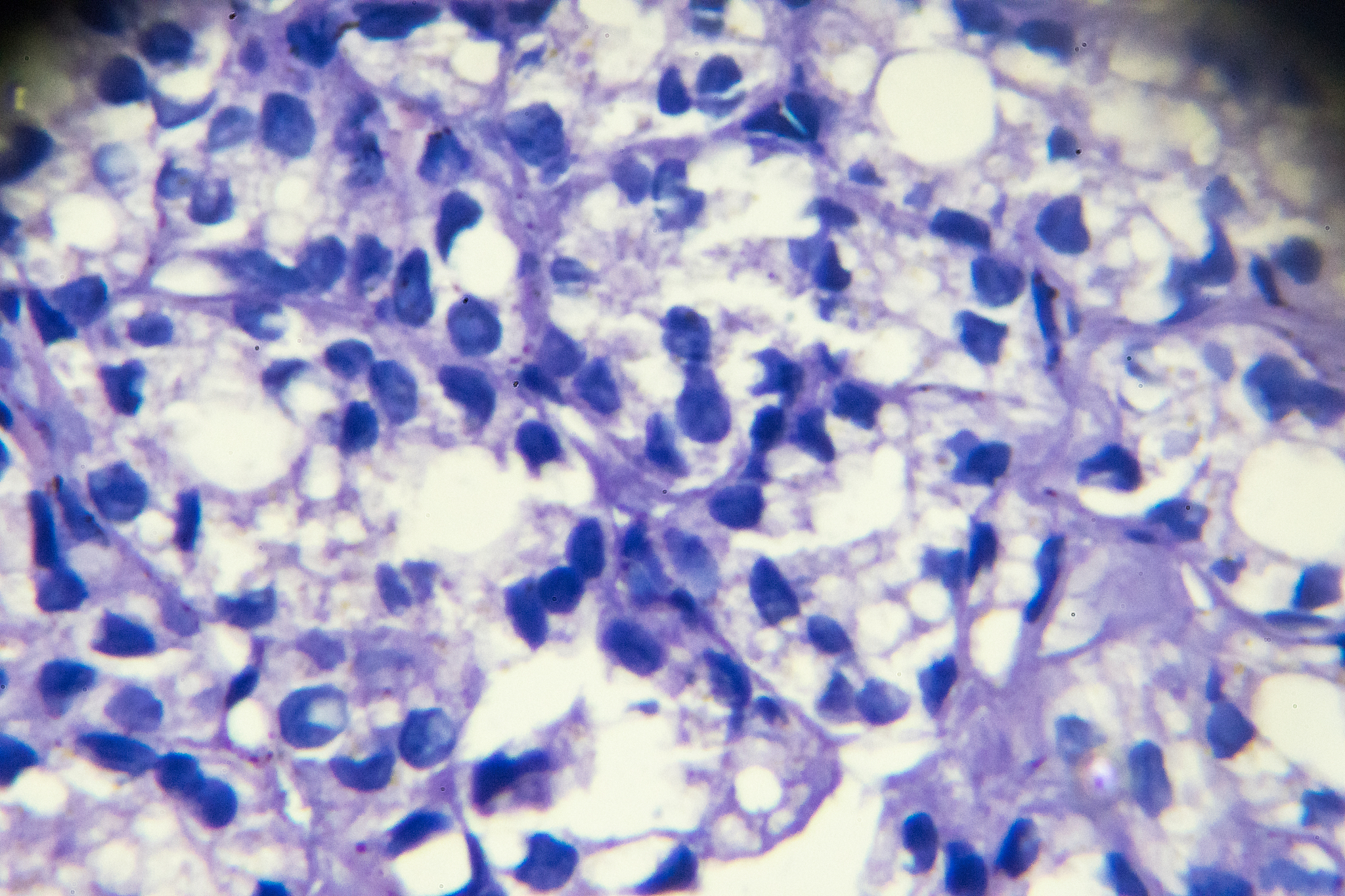 甲状腺癌分期与病理类型：影响疗效的关键因素