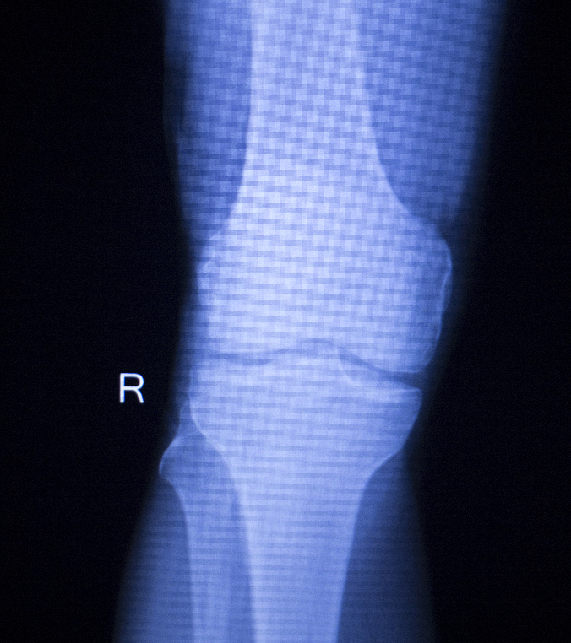 左股骨粗隆间骨折：症状、治疗及康复