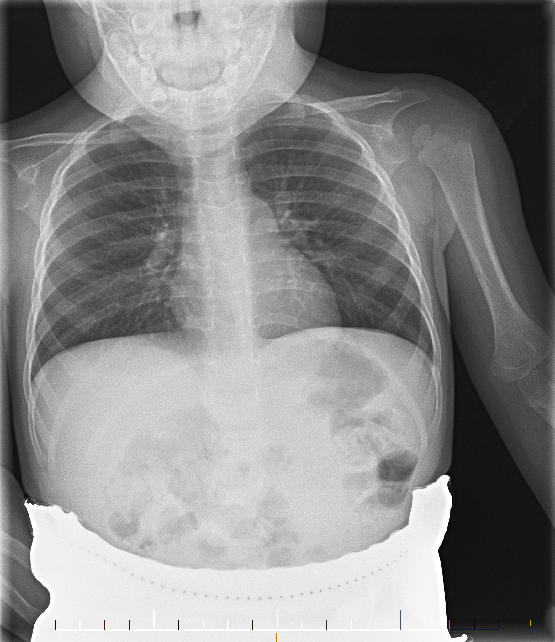 左边肋骨凸起的原因：常见病症及就医建议
